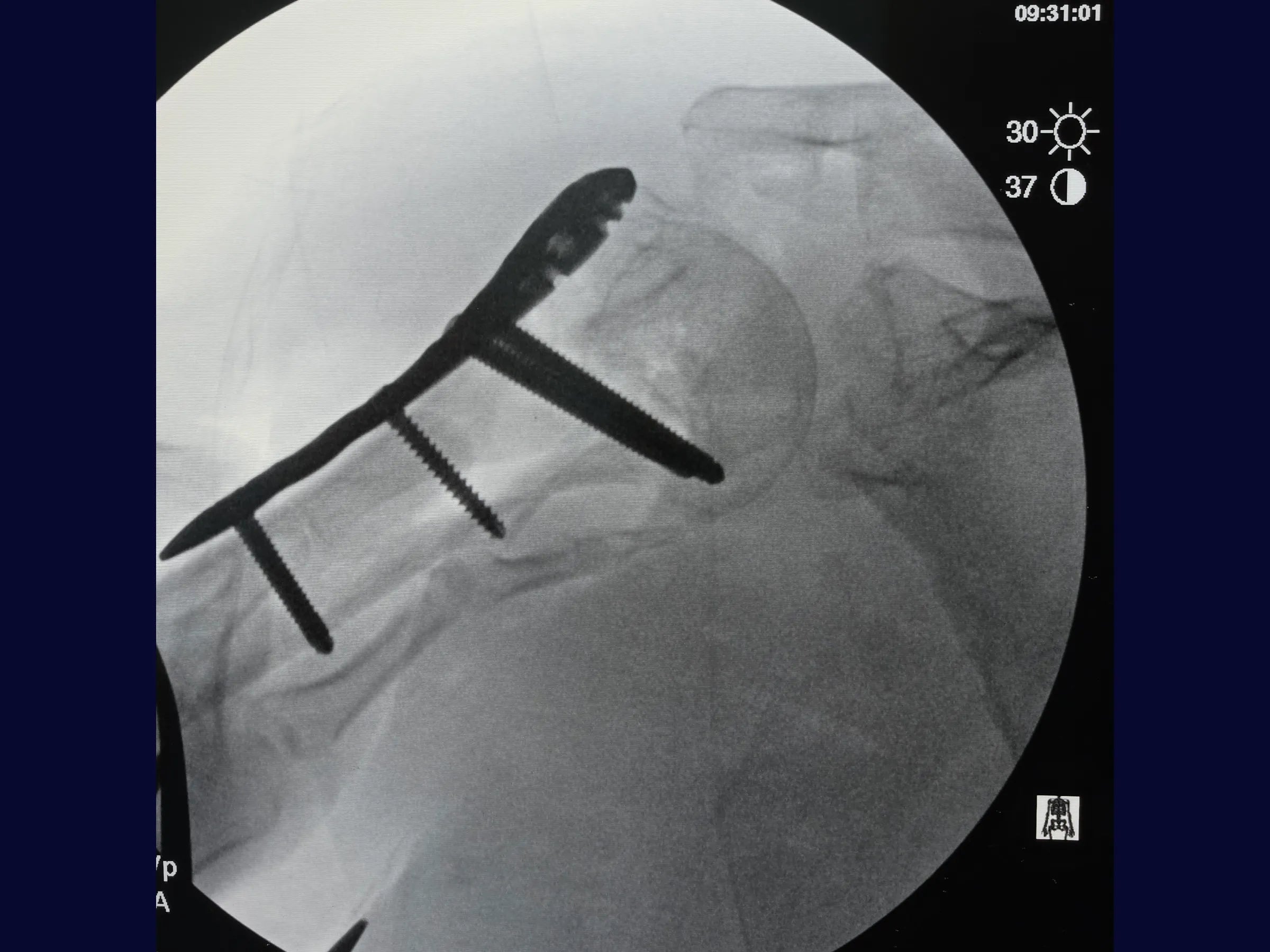 Úmero Proximal – Fratura em 4 Partes
