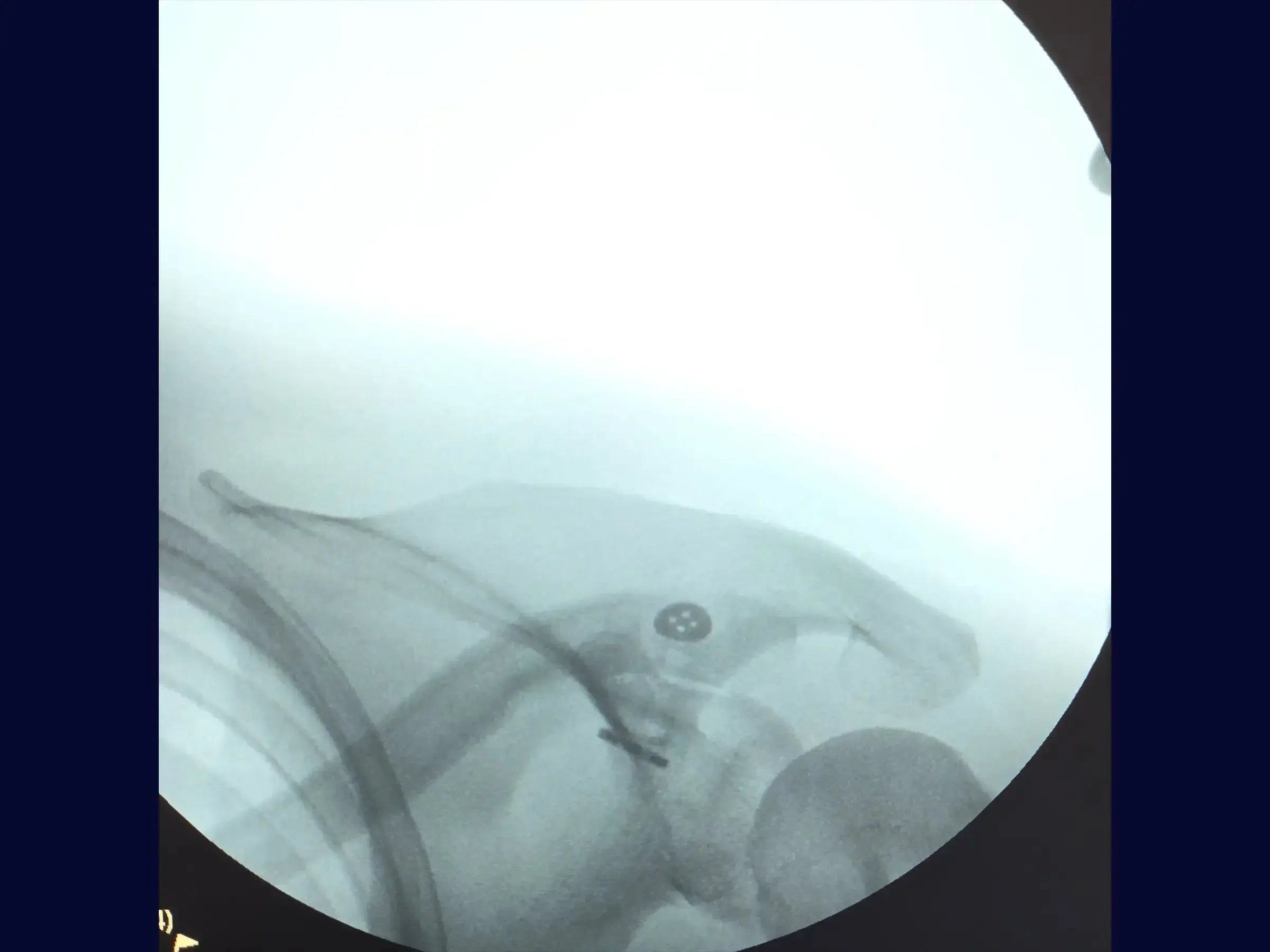 Acromioclavicular Dislocation with TightRope Device