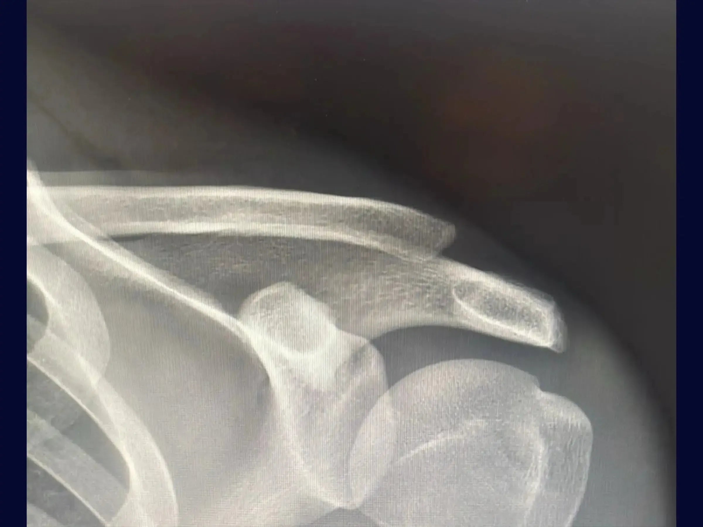 Acromioclavicular Dislocation with TightRope Device