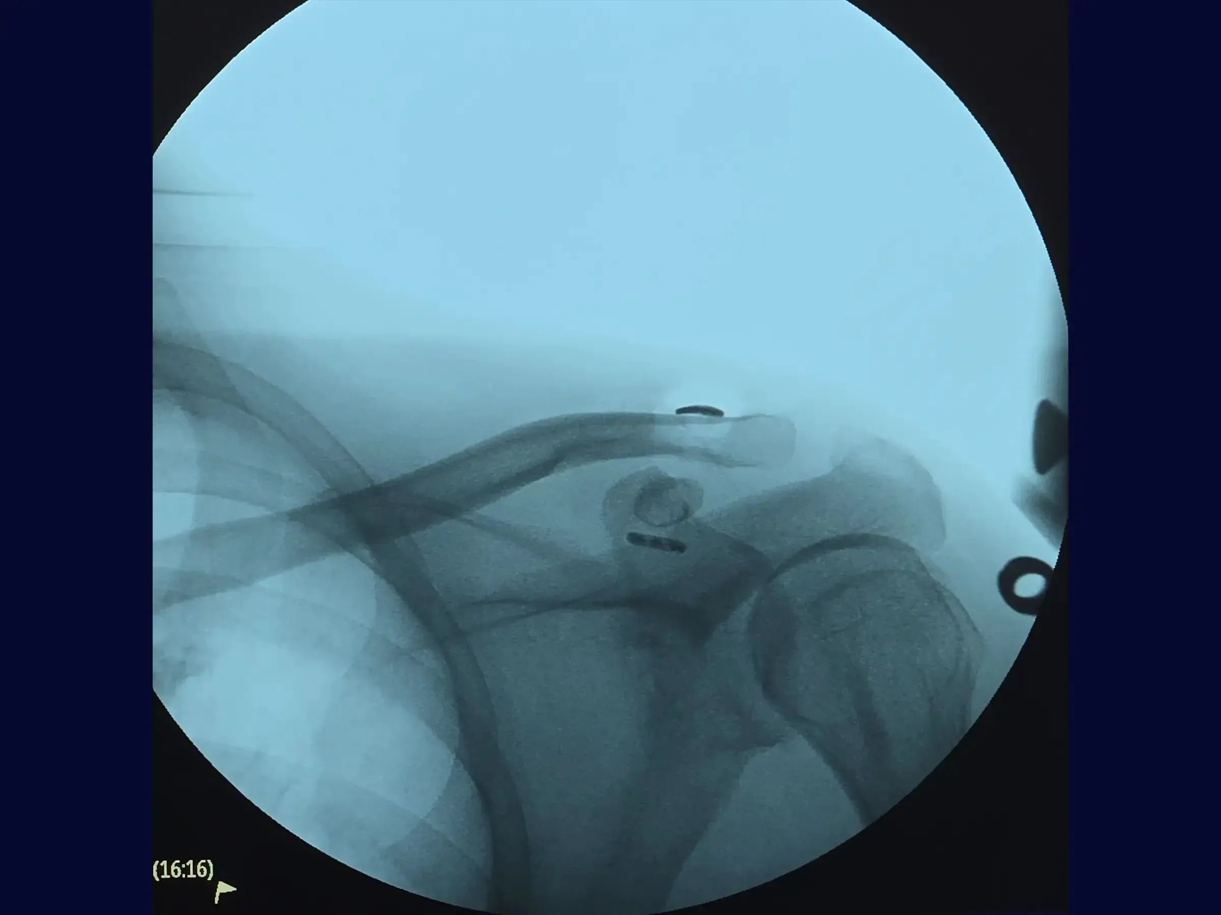 Acromioclavicular Dislocation with TightRope Device