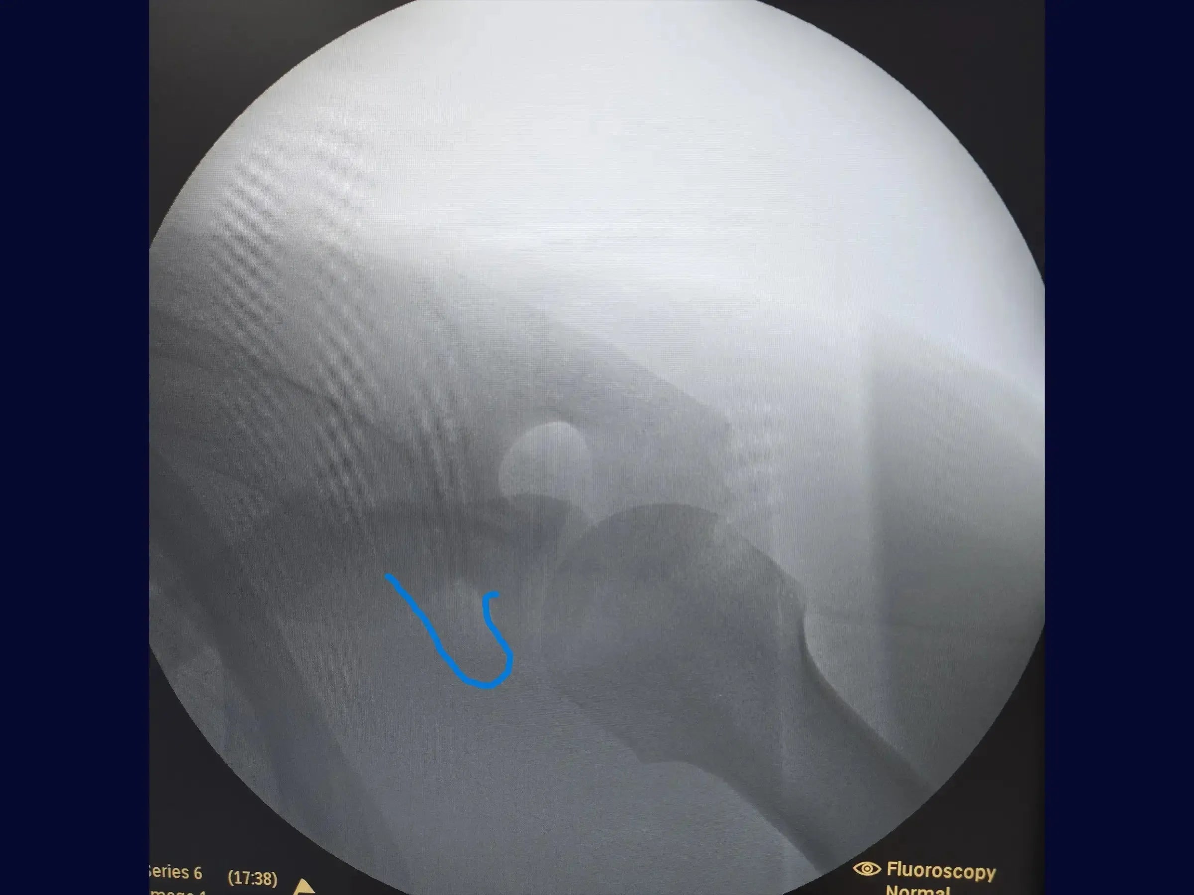Acromioclavicular Dislocation with TightRope Device