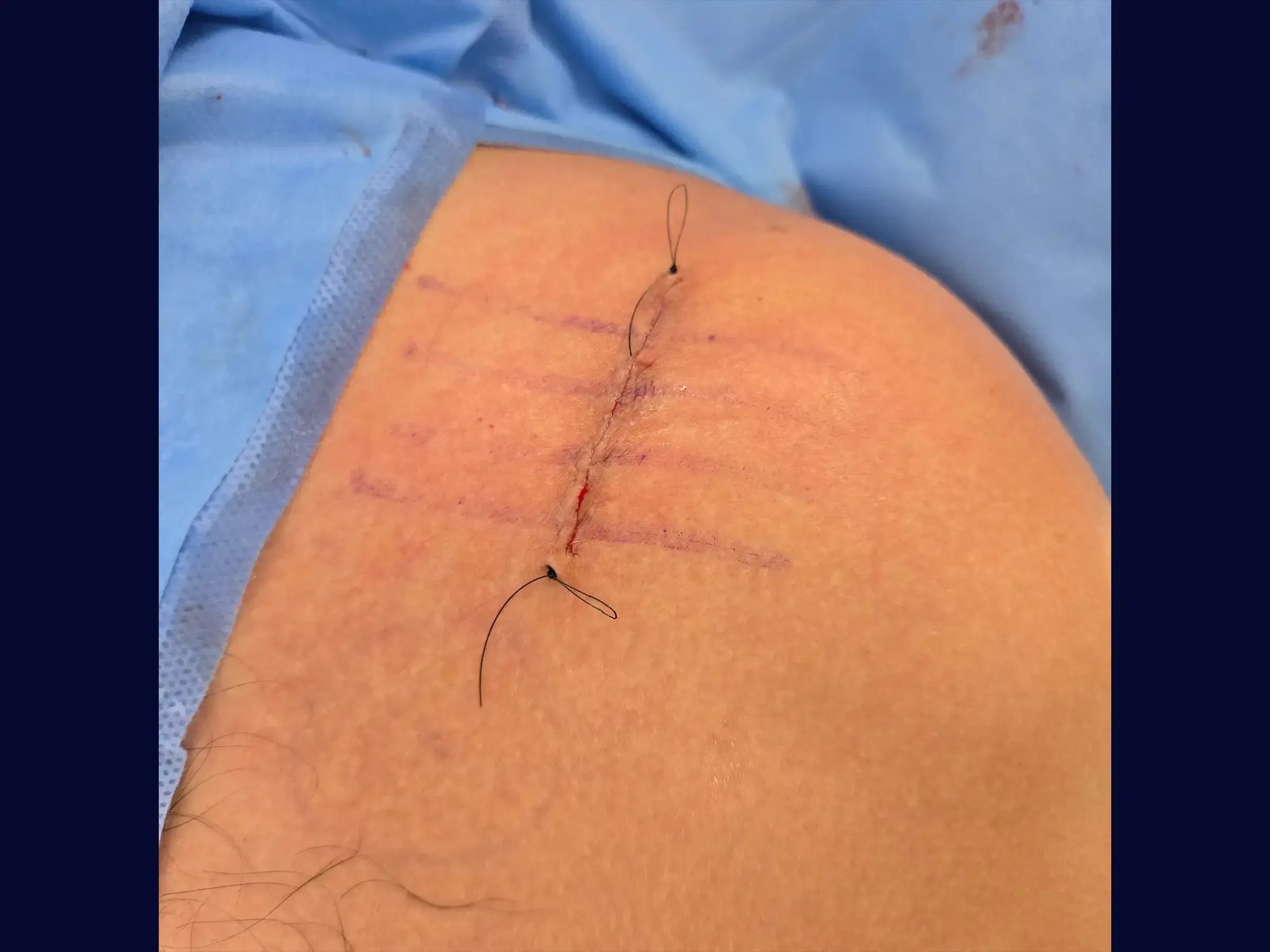 Acromioclavicular Dislocation with TightRope Device