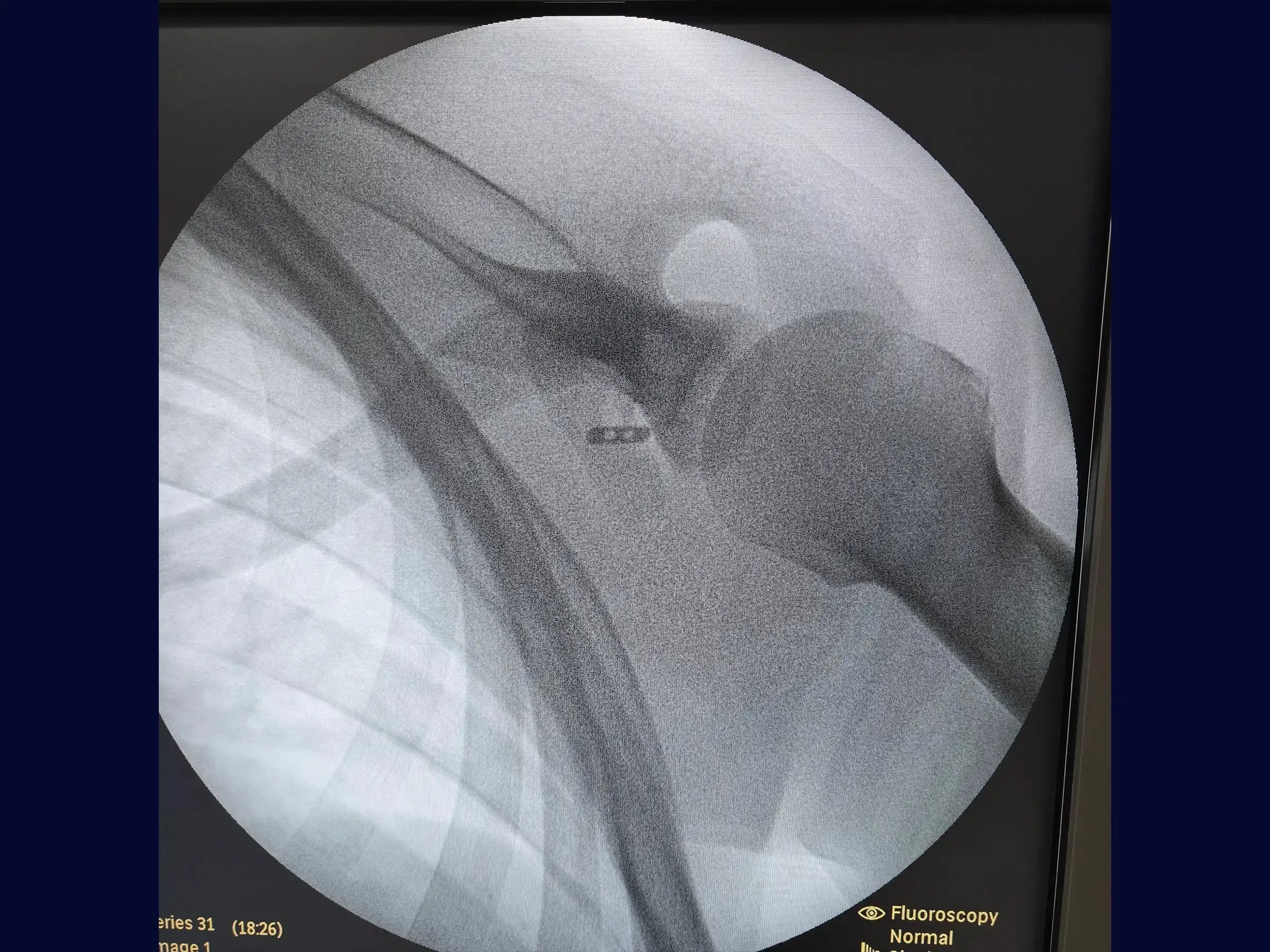 Acromioclavicular Dislocation with TightRope Device
