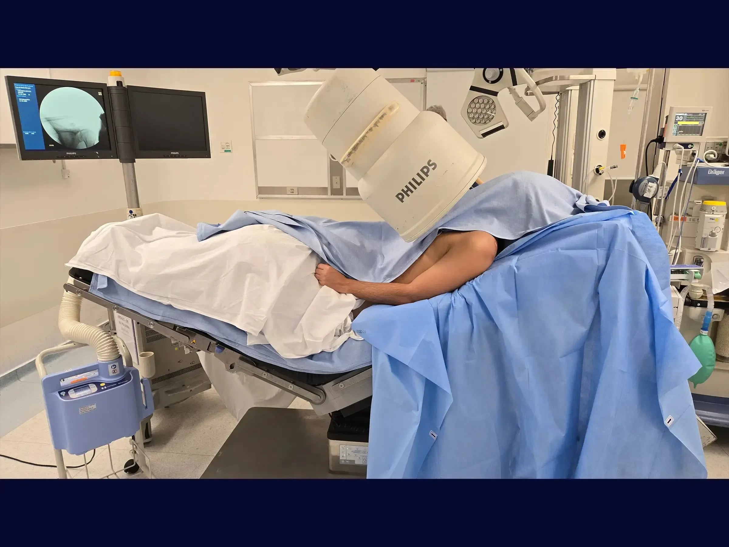 Acromioclavicular Dislocation with TightRope Device