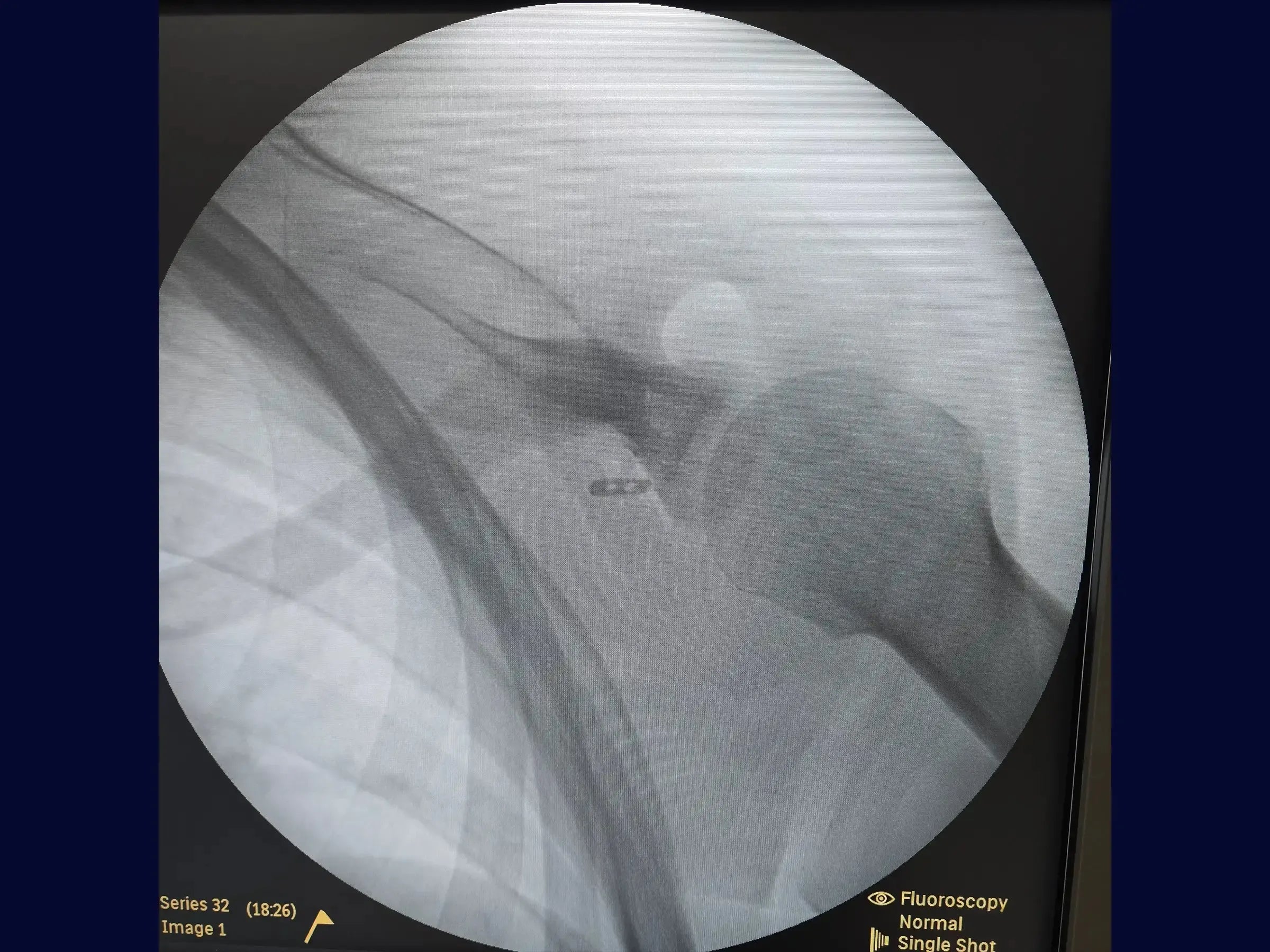 Acromioclavicular Dislocation with TightRope Device