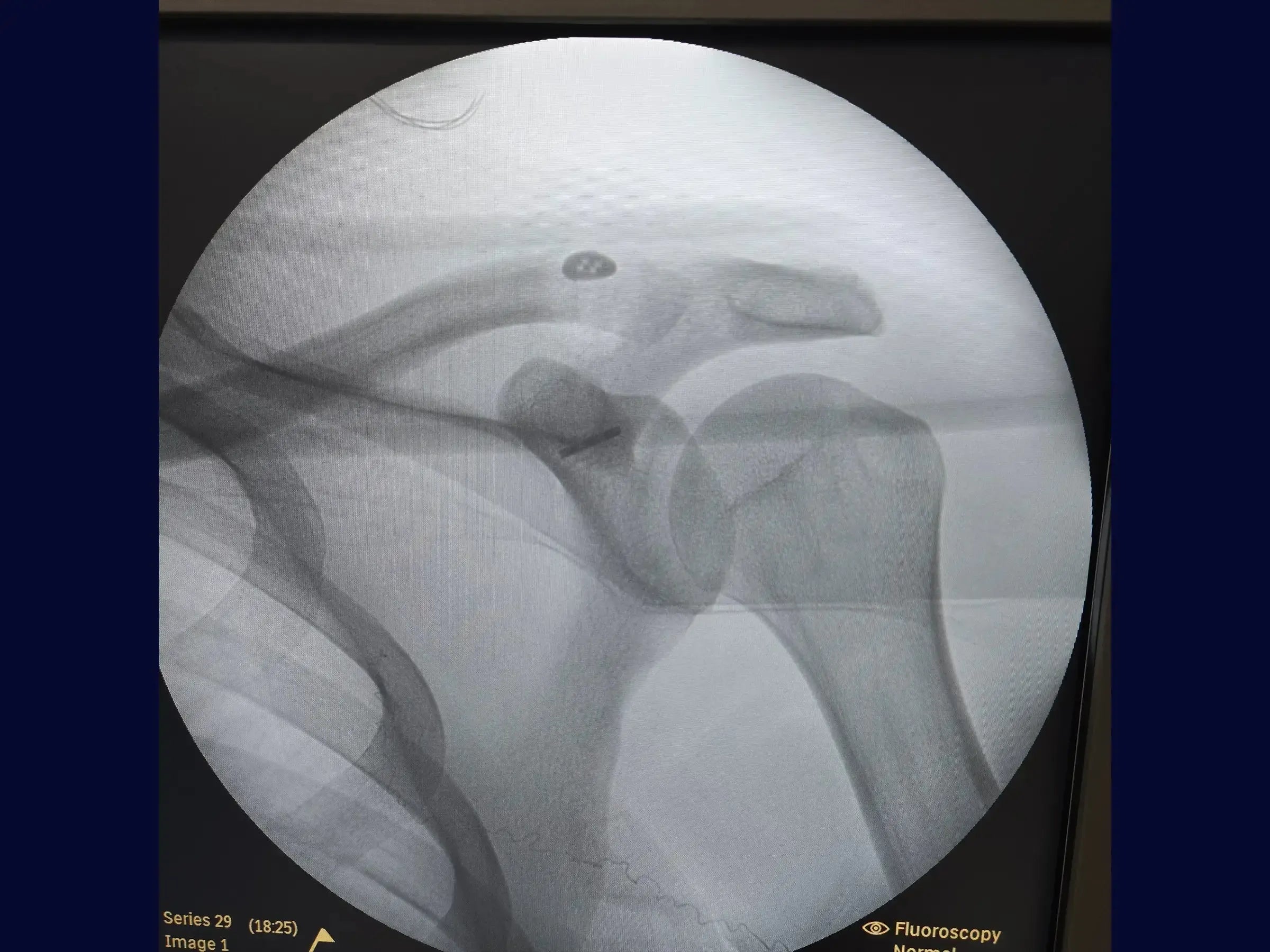 Acromioclavicular Dislocation with TightRope Device