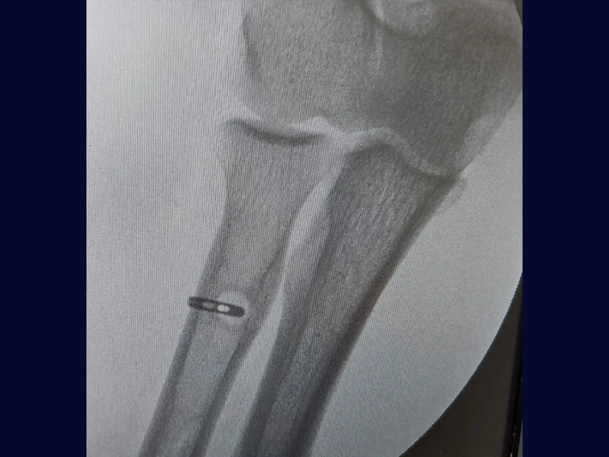 Anatomical Reconstruction of the Distal Biceps Tendon (TightRope)