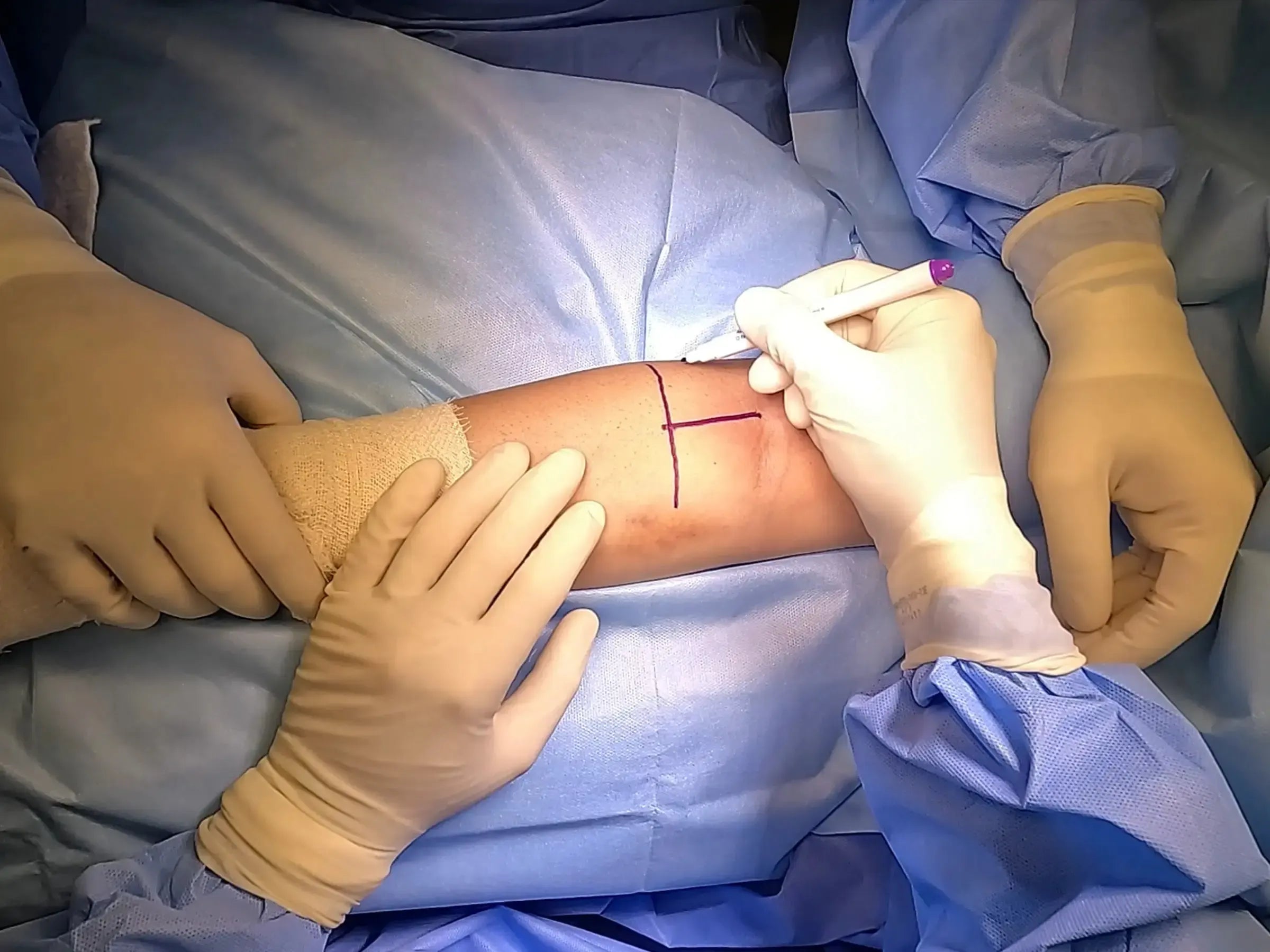 Anatomical Reconstruction of the Distal Biceps Tendon (TightRope)