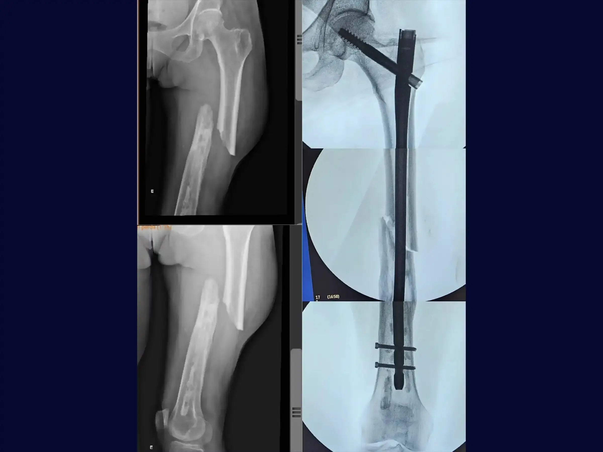 Anterograde Intramedullary Nail - Cephalomedullary