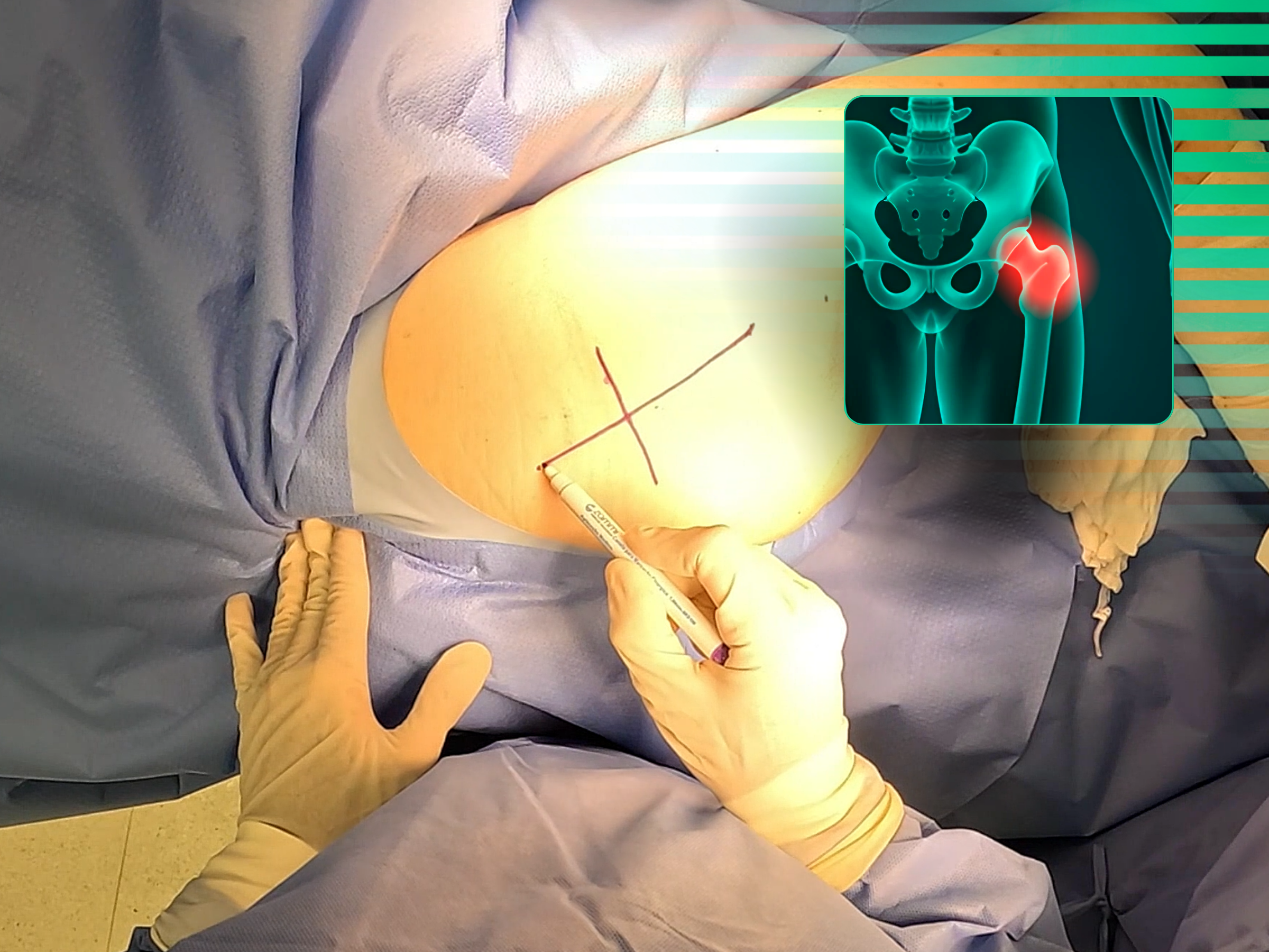 Artroplastia total de cadera (ATC) para fractura de cuello femoral (abordaje posterior)