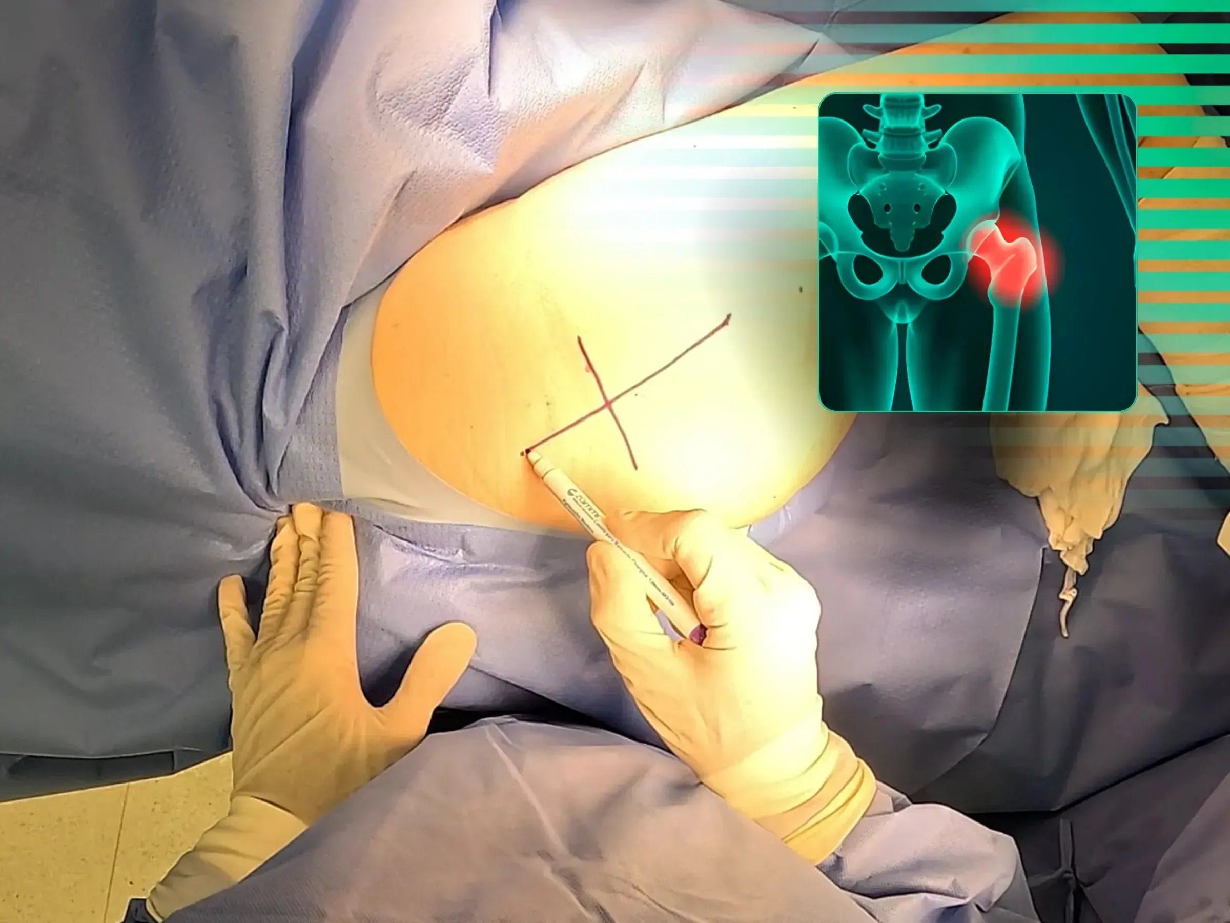 Total Hip Arthroplasty (THA) for Femoral Neck Fracture (Posterior Approach)