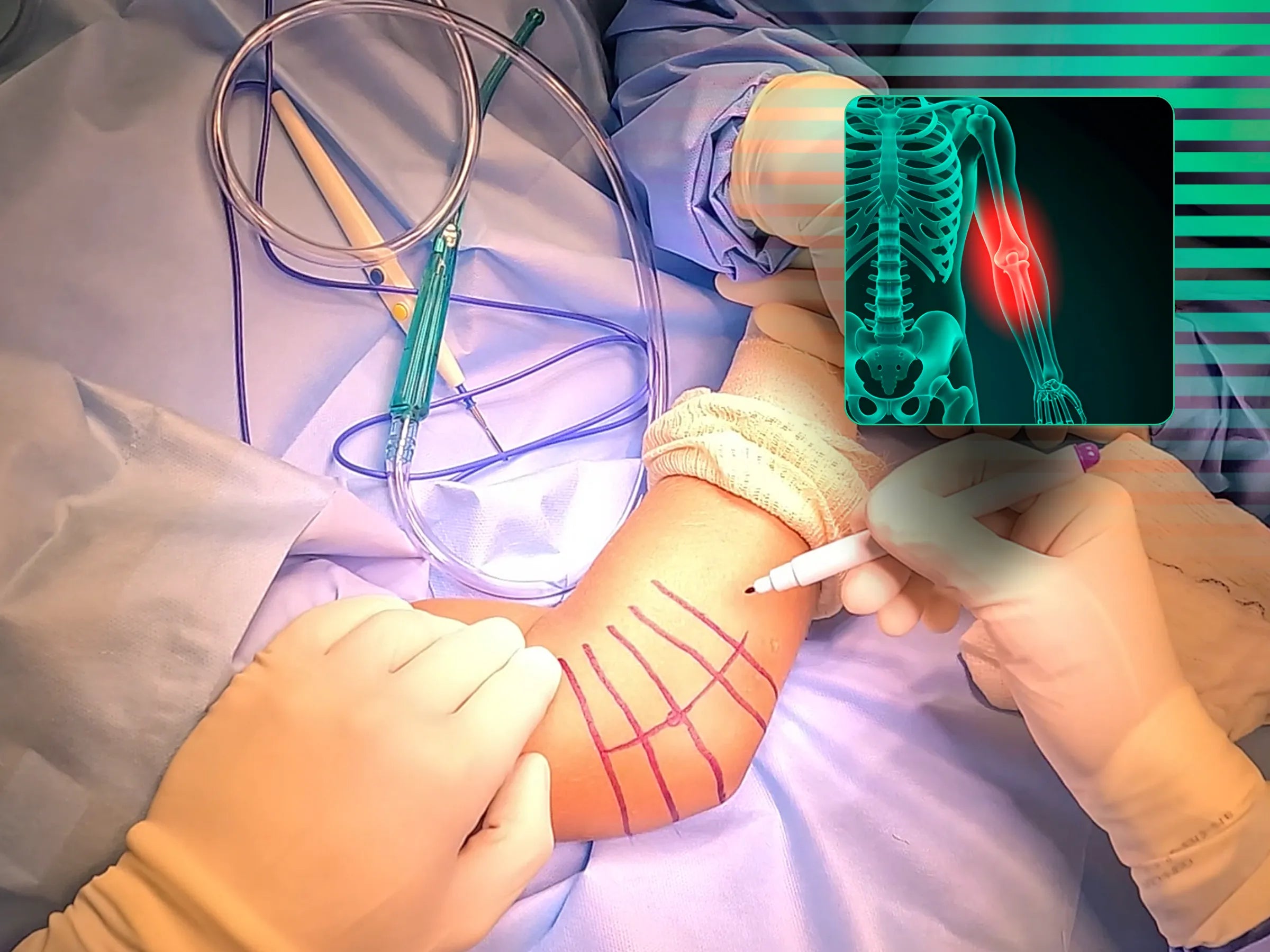Artroplastia da Cabeça do Rádio por Fratura Multifragmentar