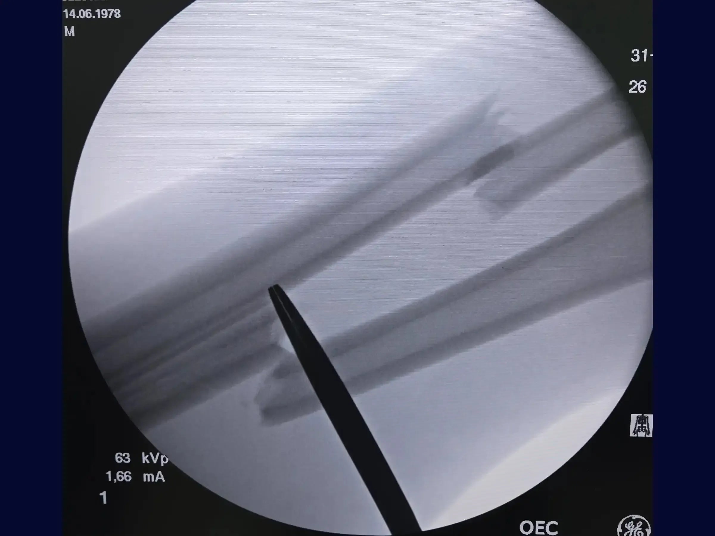 Diaphyseal Fractures of the Radius and Ulna