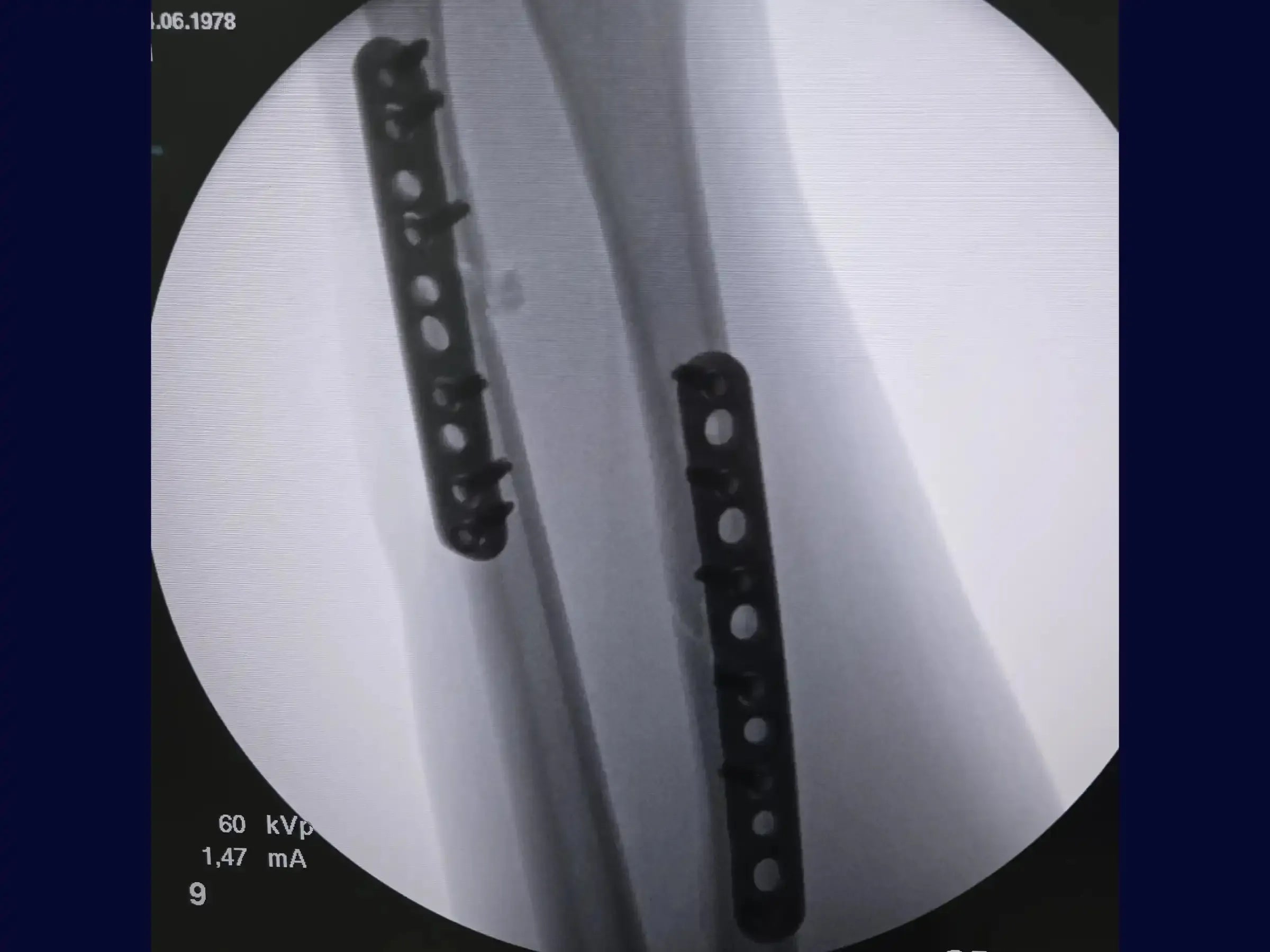 Diaphyseal Fractures of the Radius and Ulna