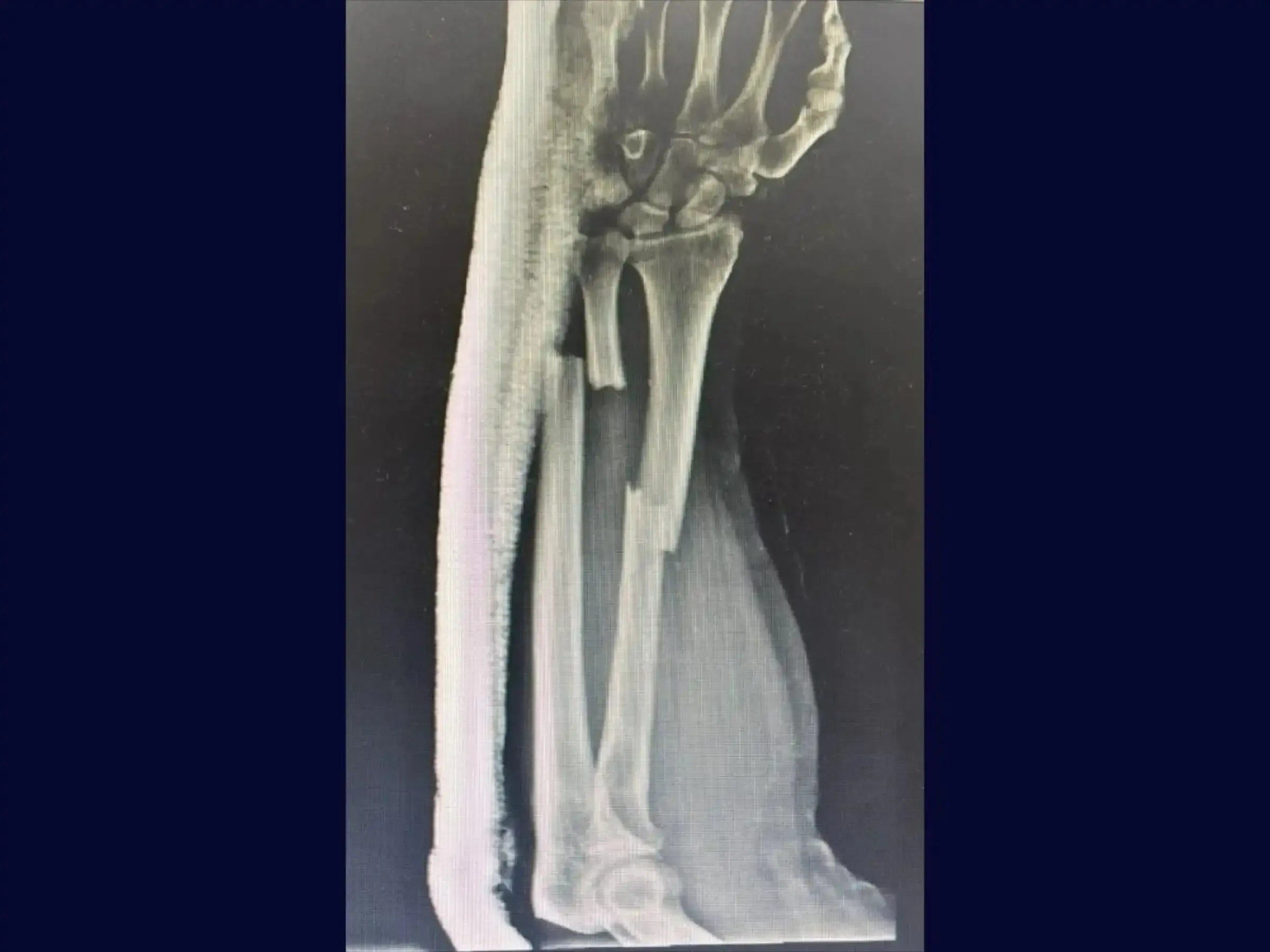 Diaphyseal Fractures of the Radius and Ulna