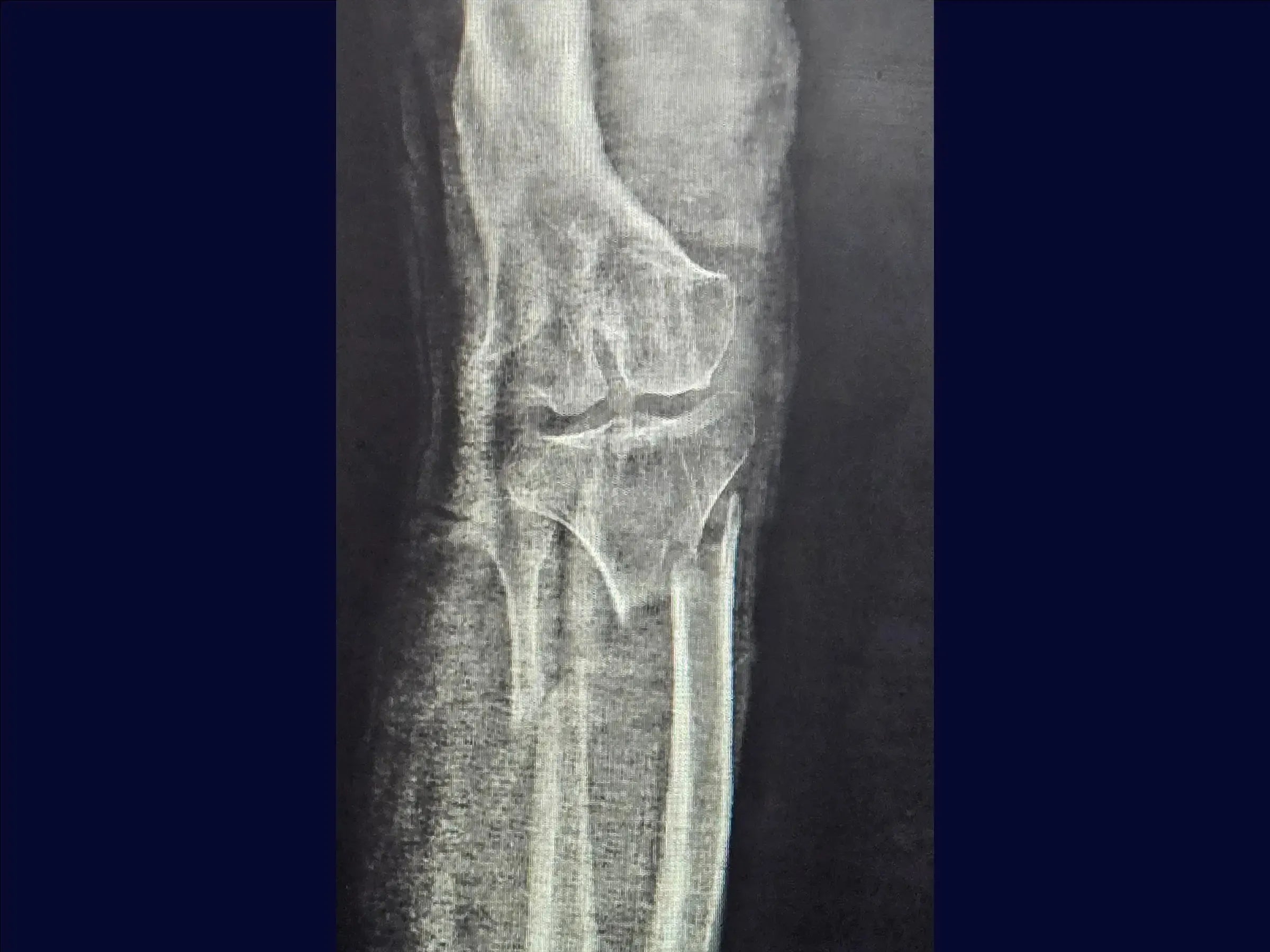 Diaphyseal Tibia Fracture with Deformity