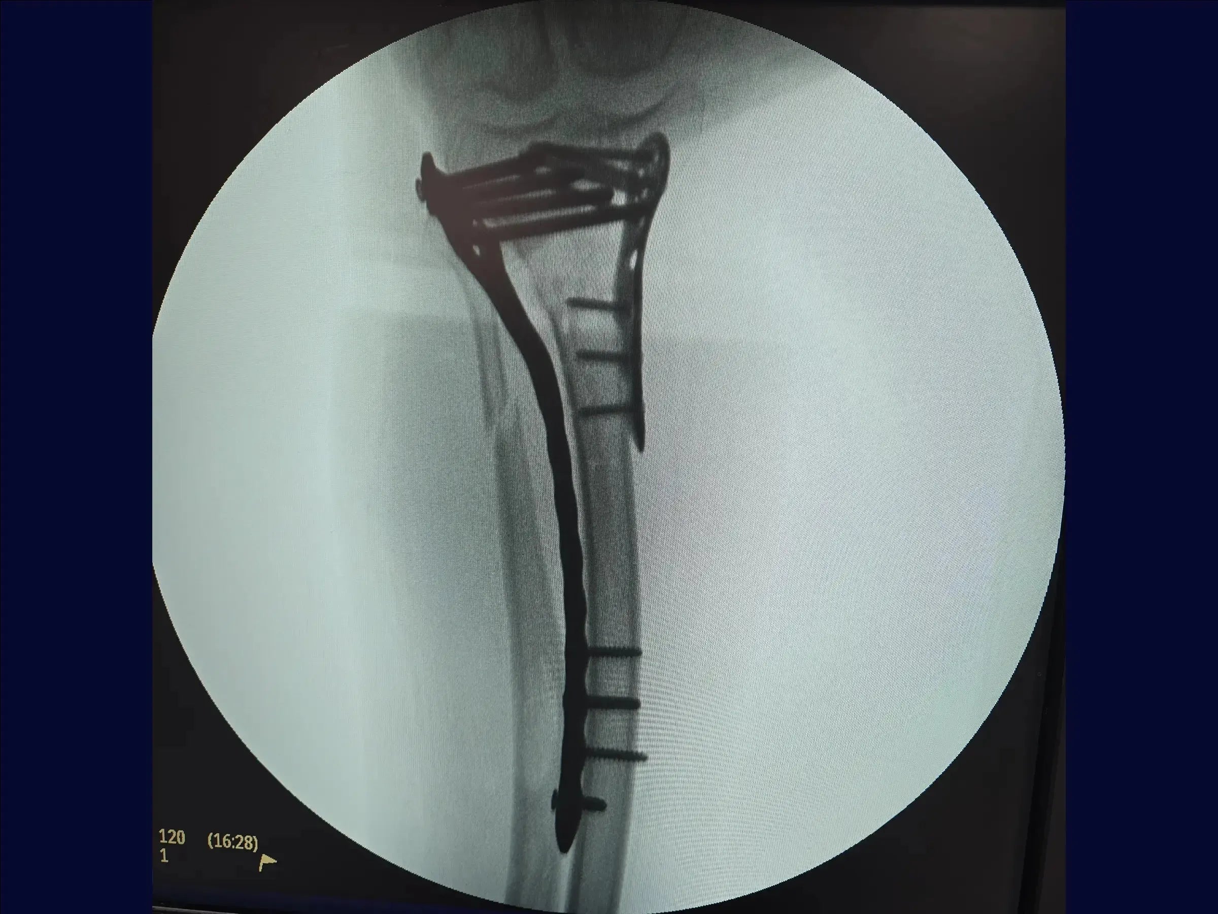 Diaphyseal Tibia Fracture with Deformity