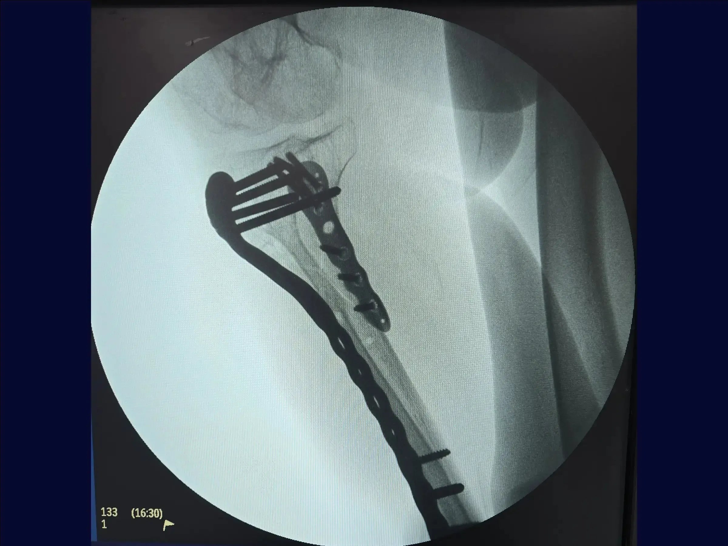Diaphyseal Tibia Fracture with Deformity