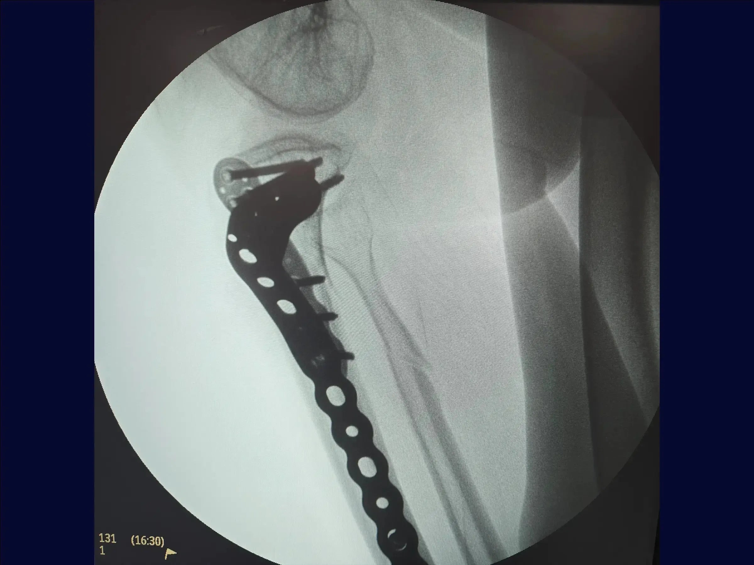 Diaphyseal Tibia Fracture with Deformity
