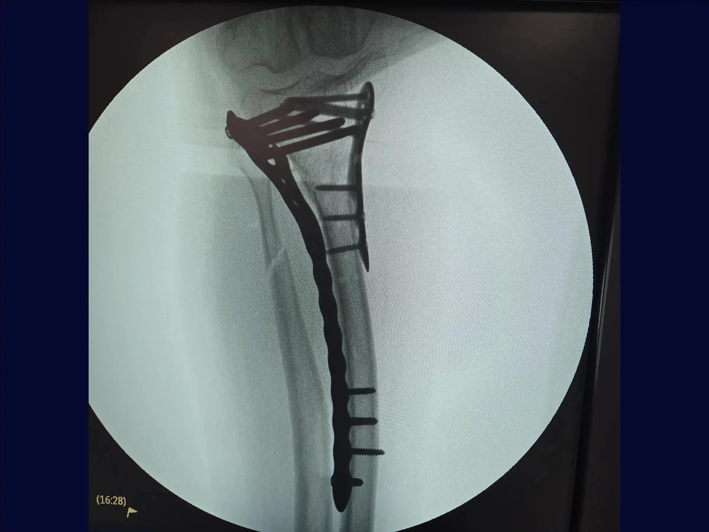 Diaphyseal Tibia Fracture with Deformity