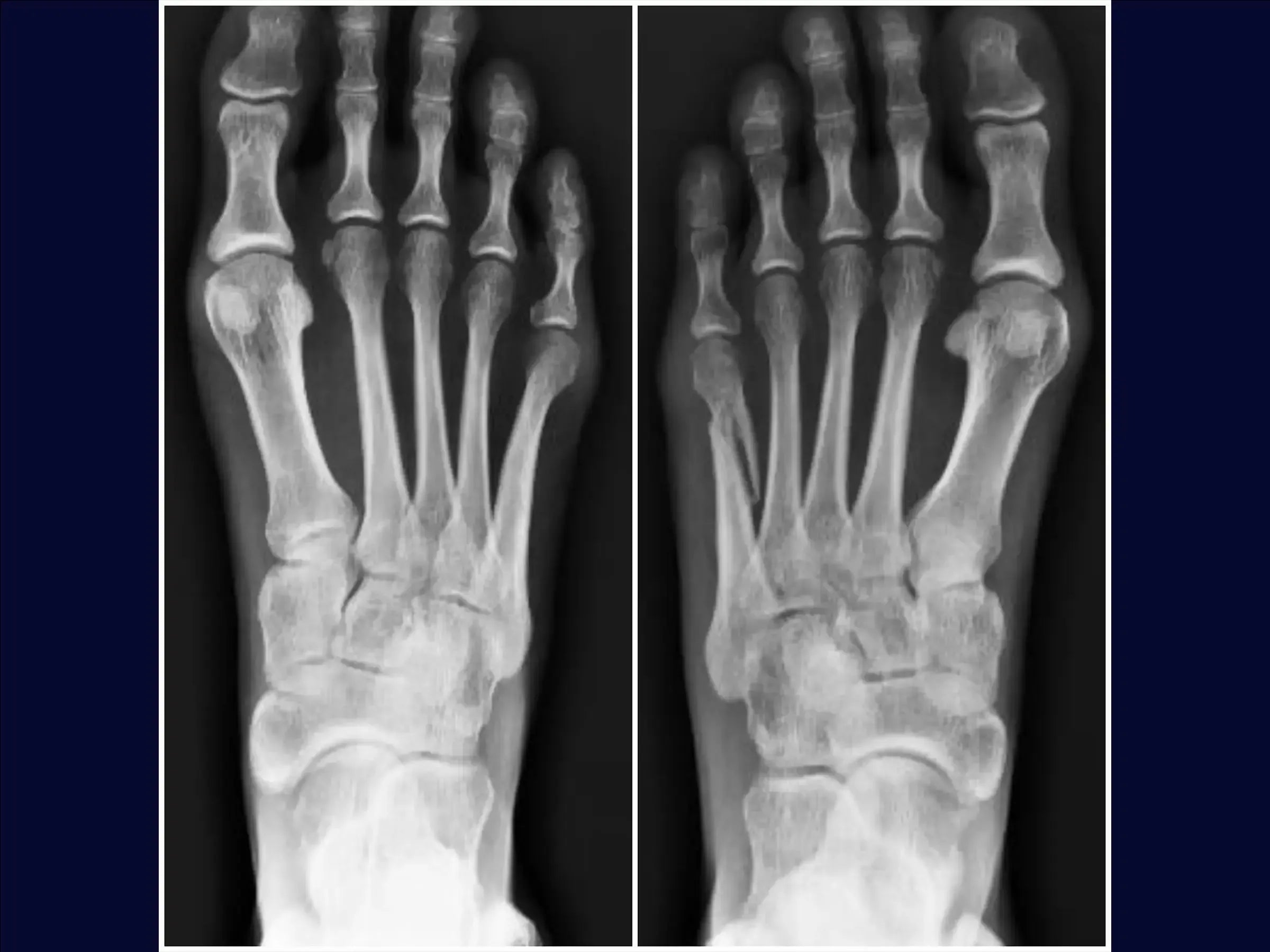 Displaced Fracture of the Fifth Metatarsal