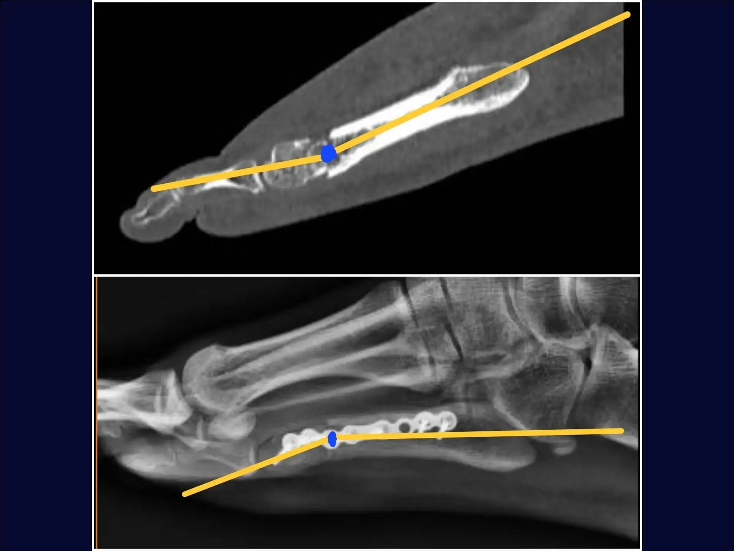 Displaced Fracture of the Fifth Metatarsal