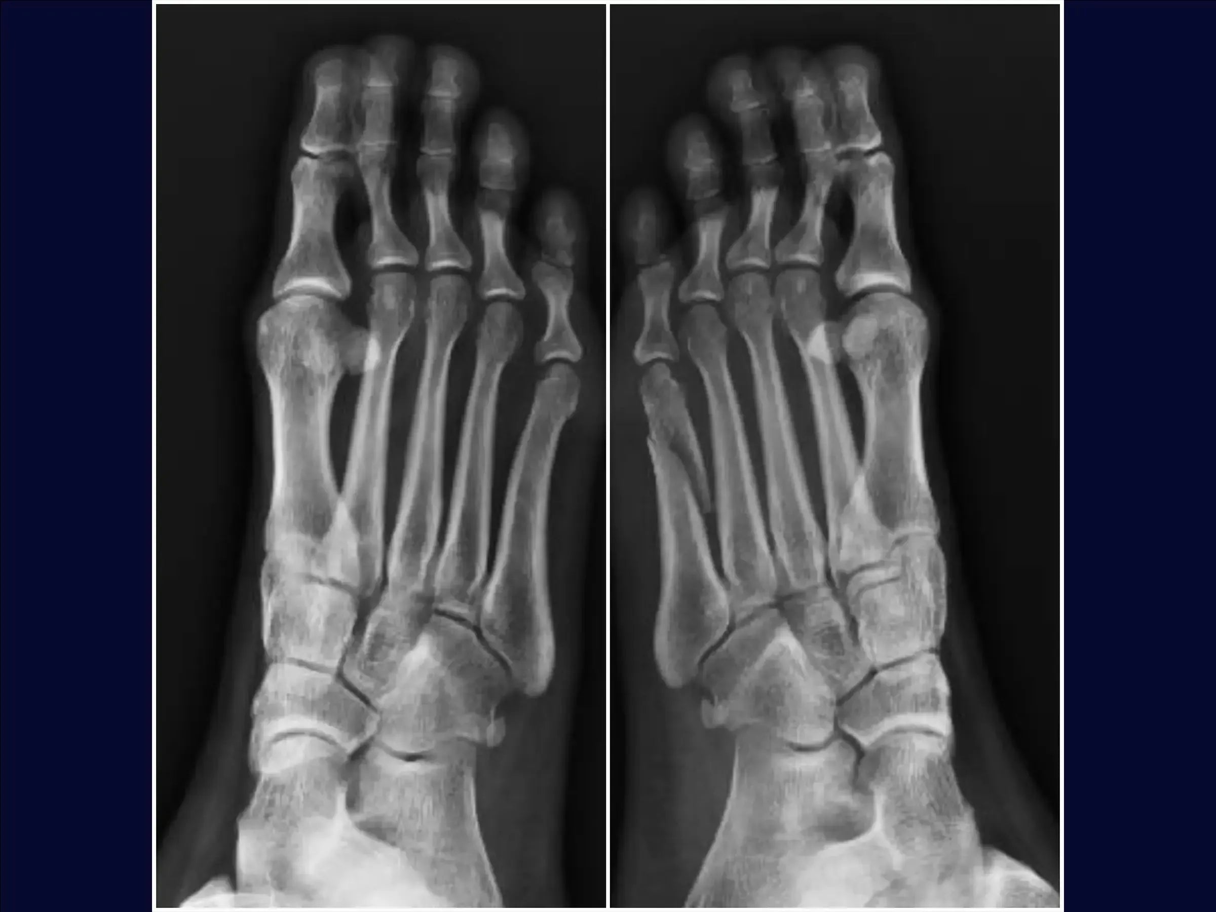 Displaced Fracture of the Fifth Metatarsal