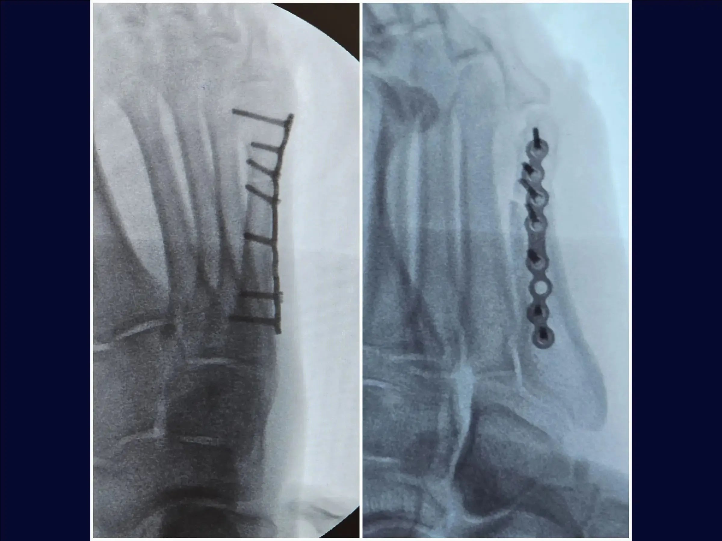 Displaced Fracture of the Fifth Metatarsal