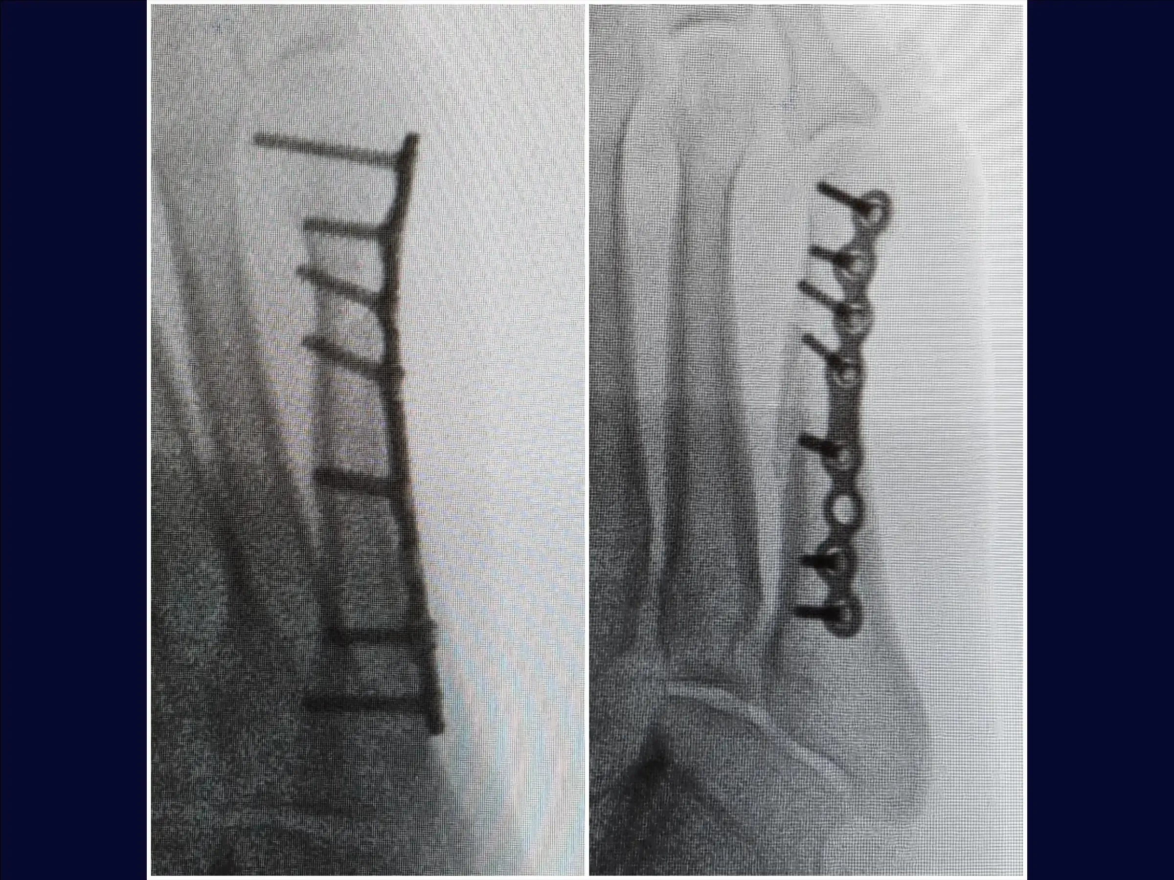 Displaced Fracture of the Fifth Metatarsal