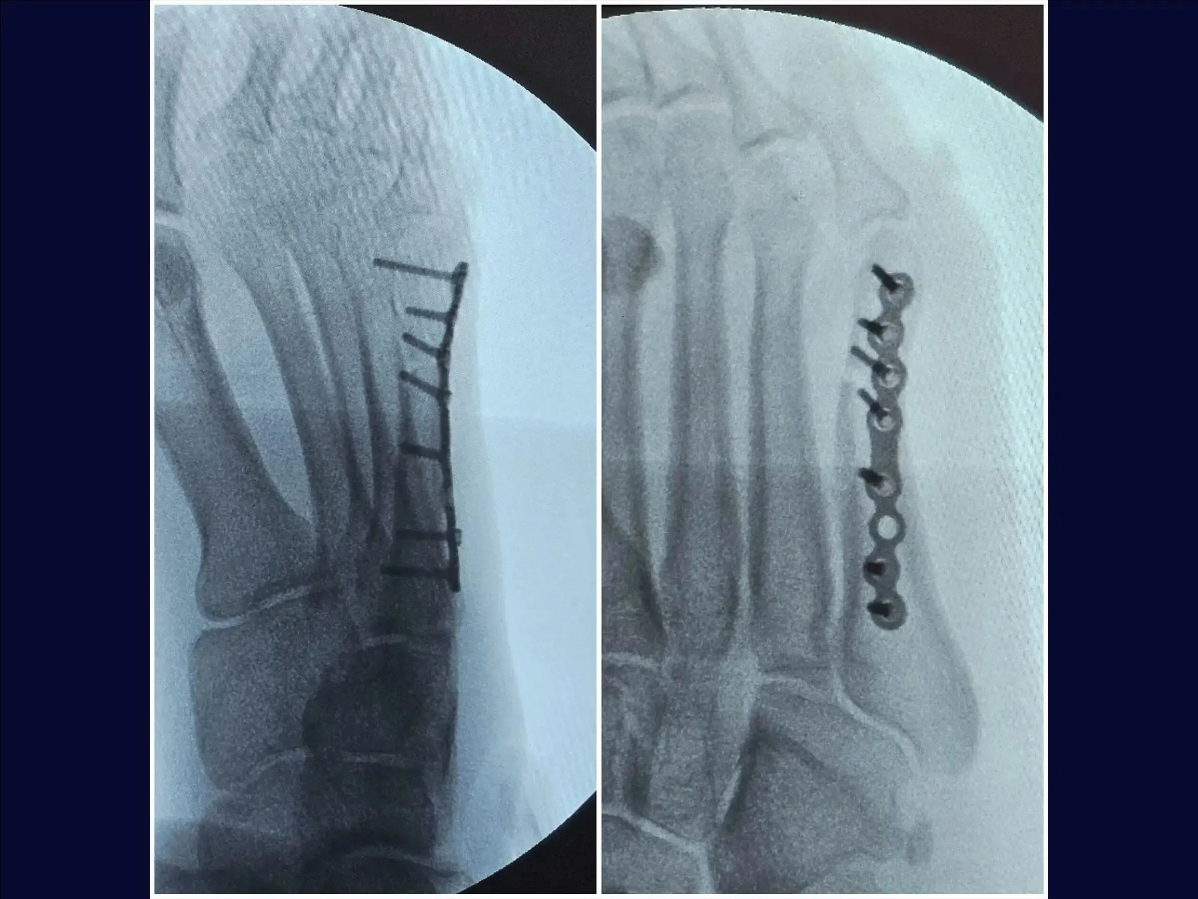 Displaced Fracture of the Fifth Metatarsal