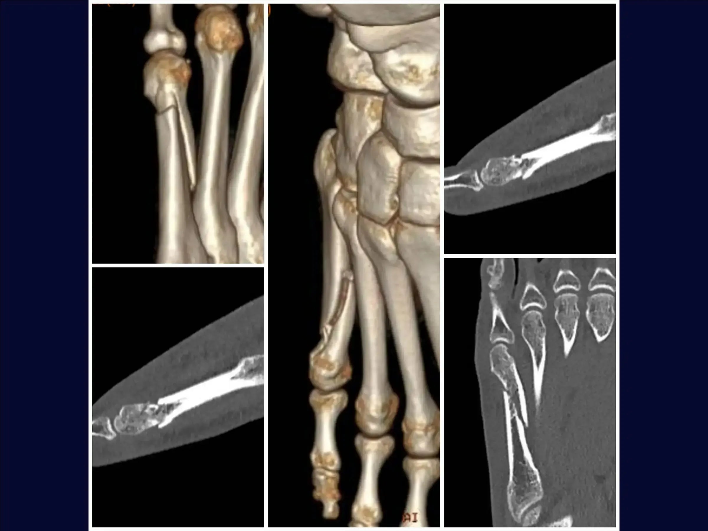 Displaced Fracture of the Fifth Metatarsal