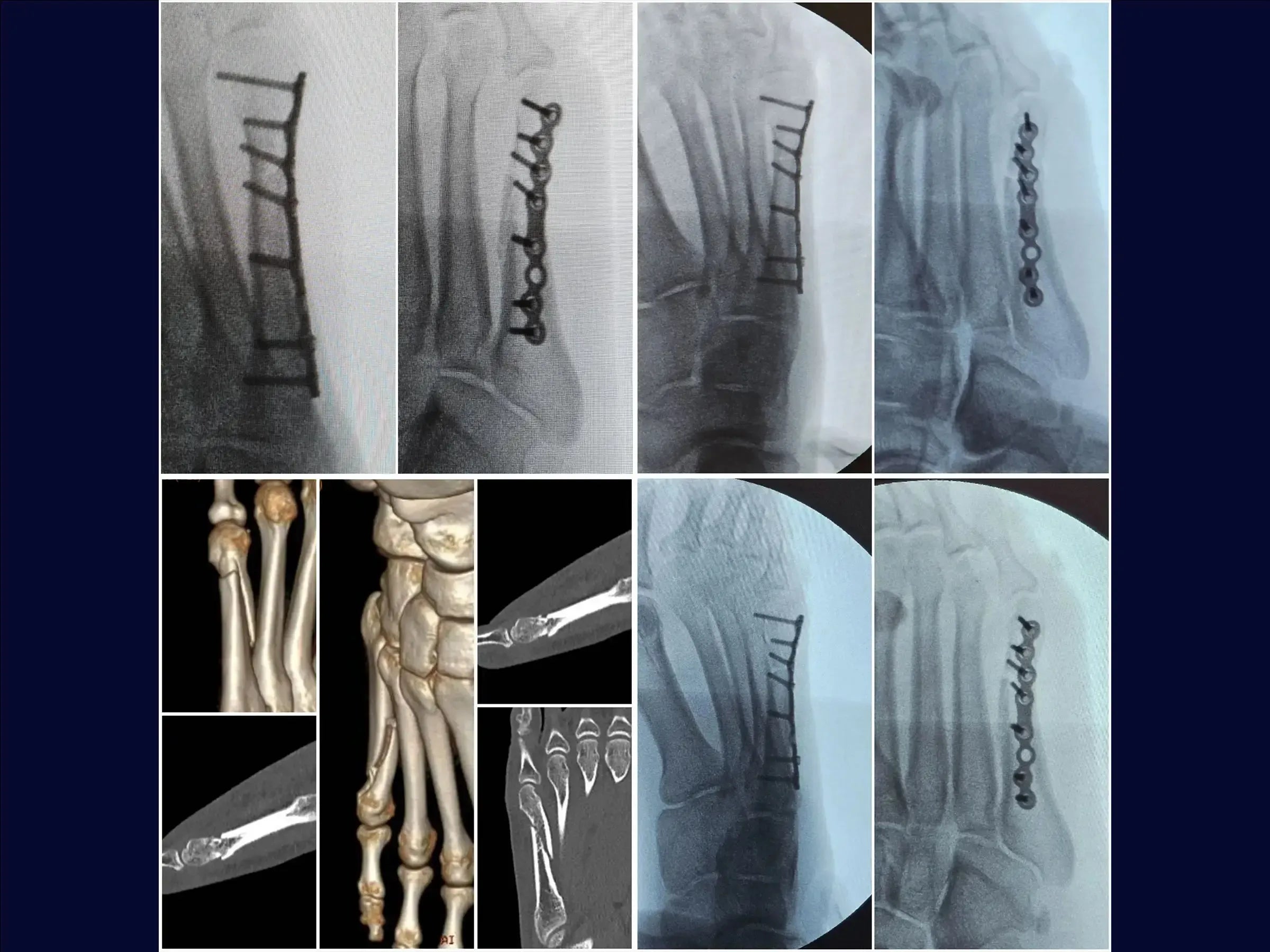 Displaced Fracture of the Fifth Metatarsal