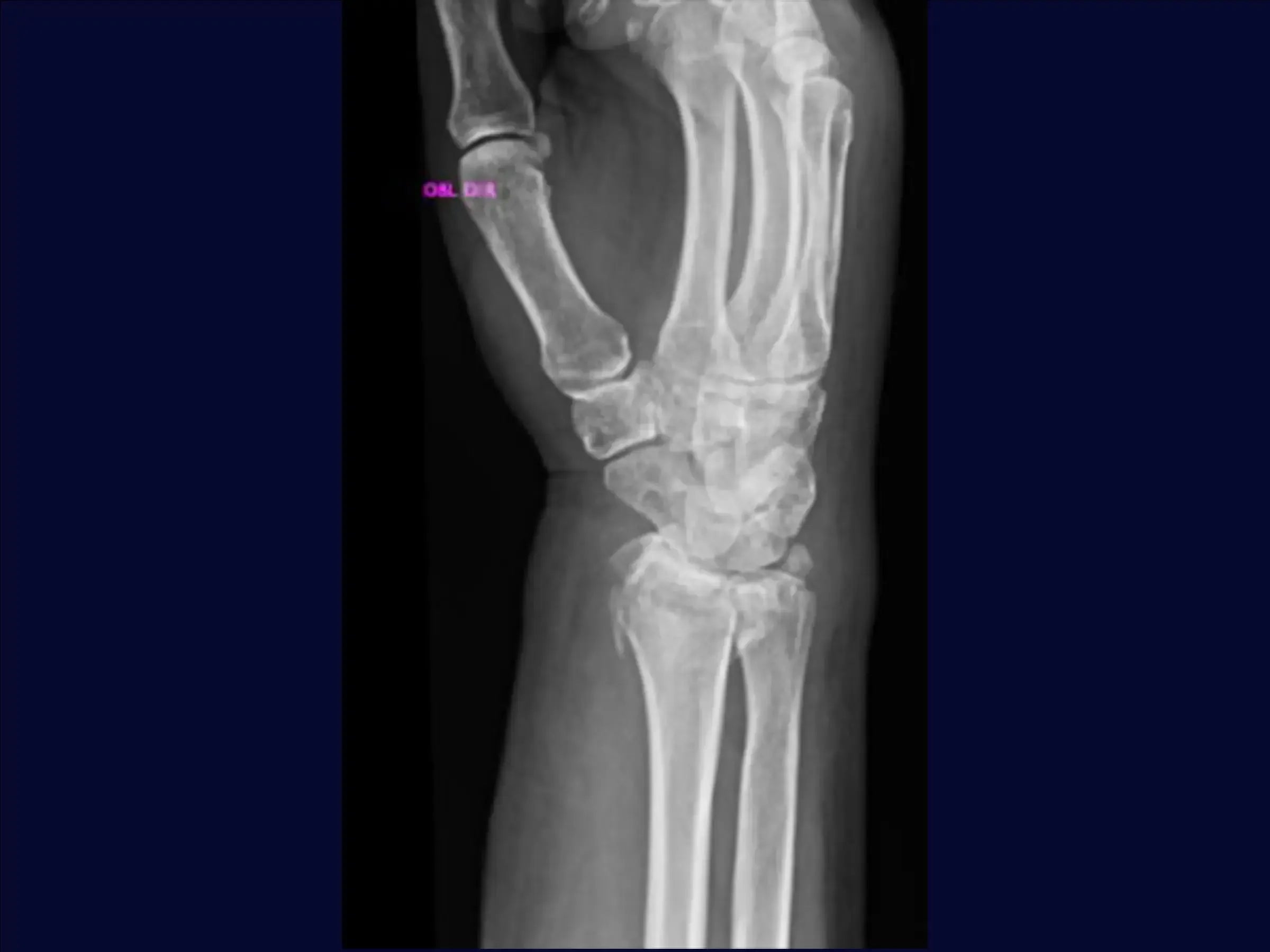 Distal Radius Fracture (Volar Approach