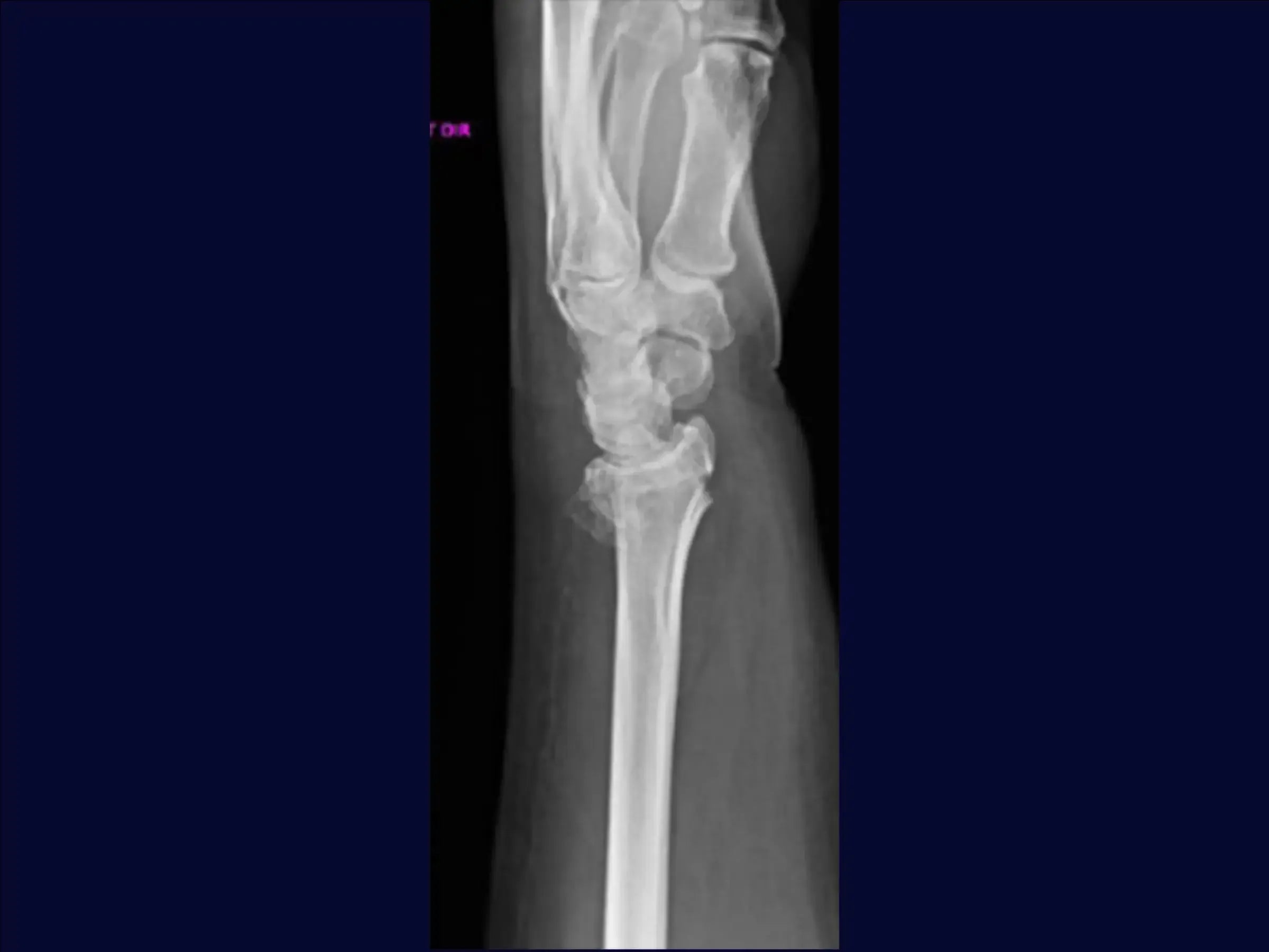 Distal Radius Fracture (Volar Approach