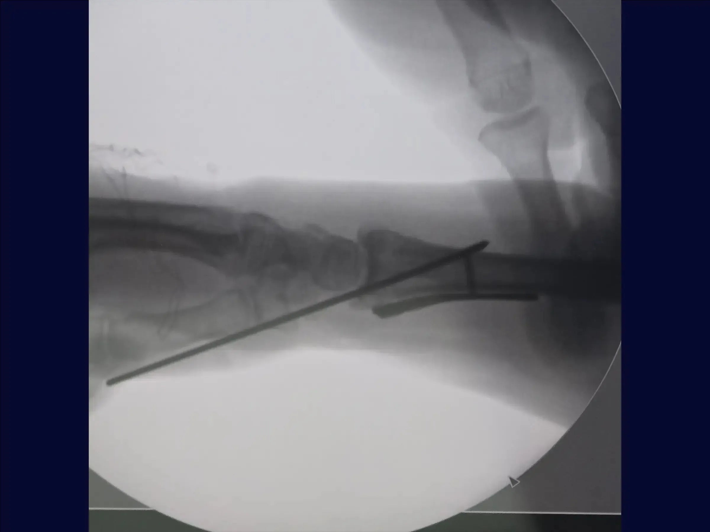 Distal Radius Fracture (Volar Approach