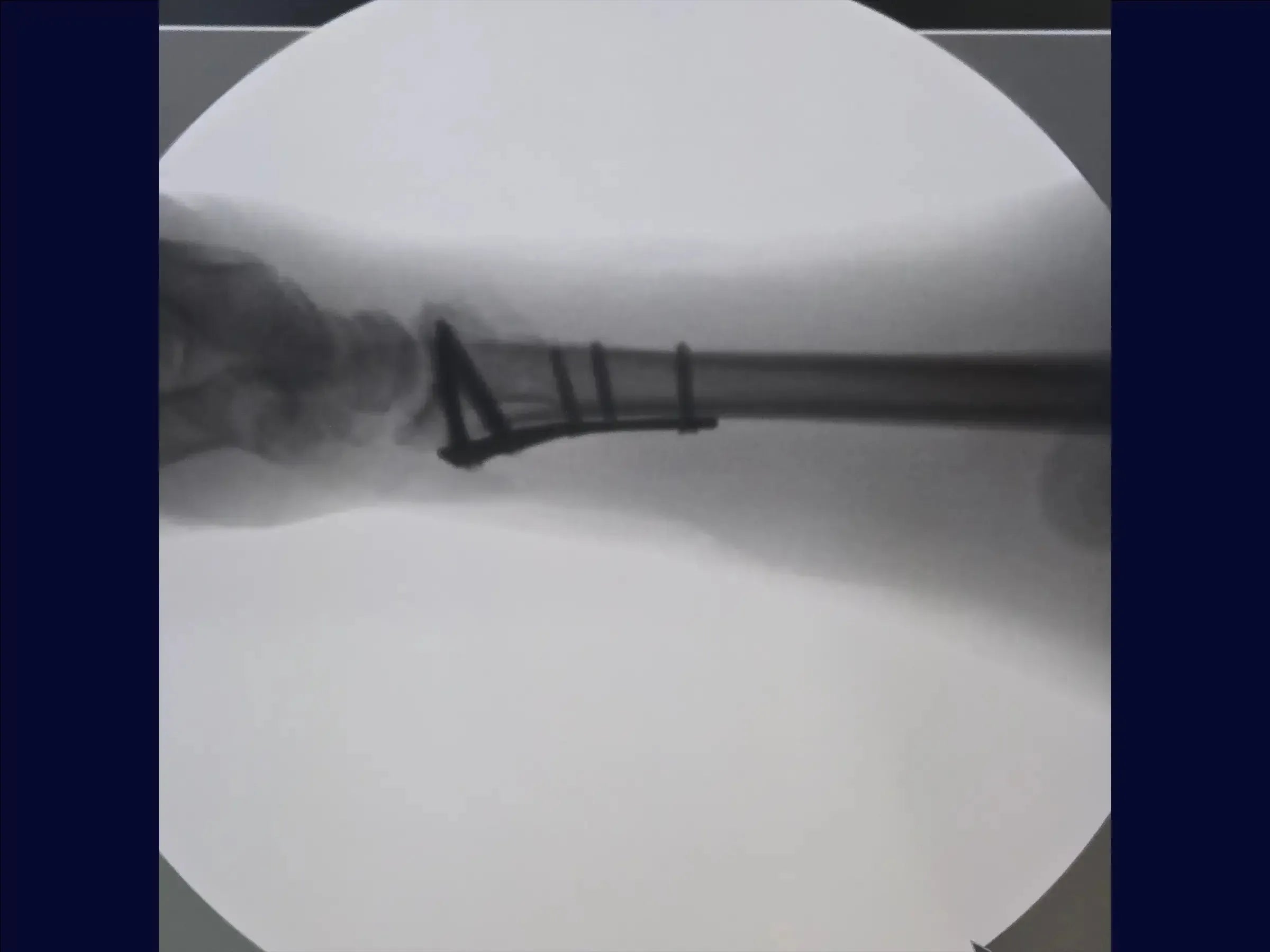 Distal Radius Fracture (Volar Approach