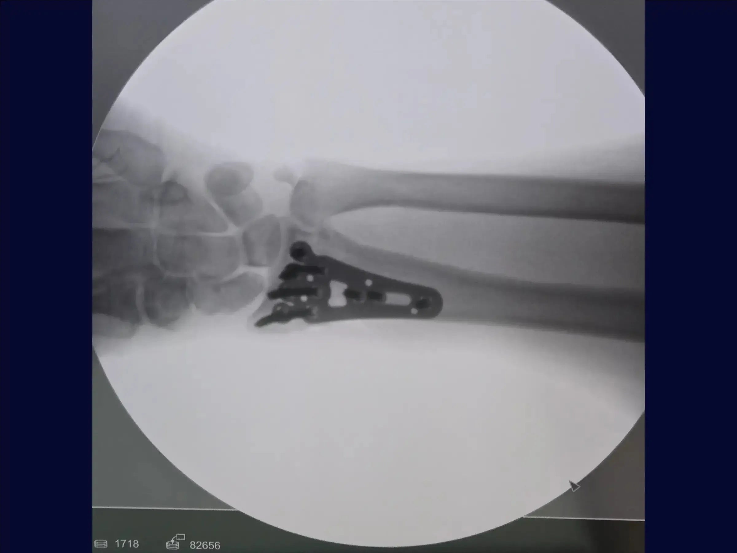 Distal Radius Fracture (Volar Approach