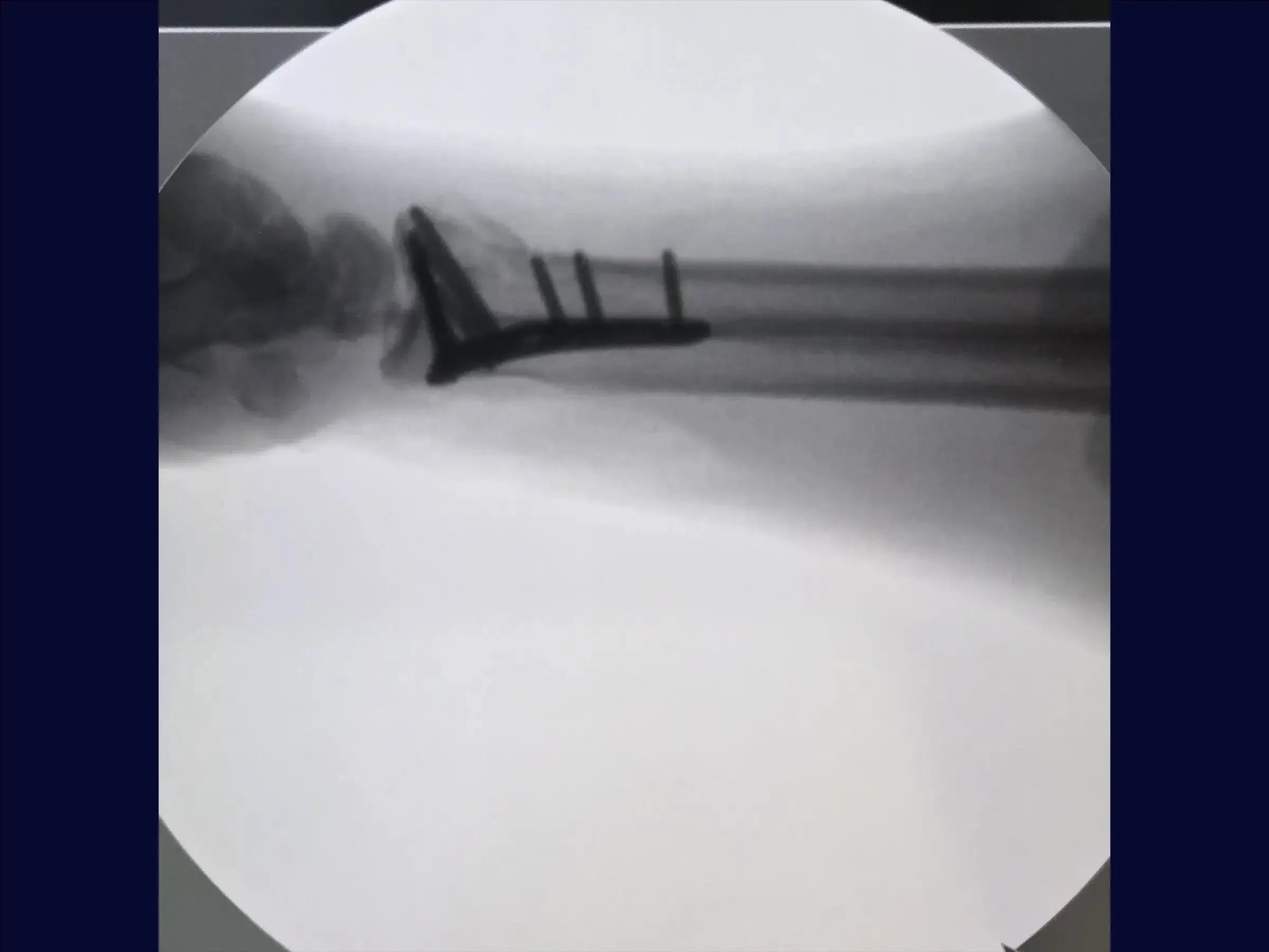 Distal Radius Fracture (Volar Approach