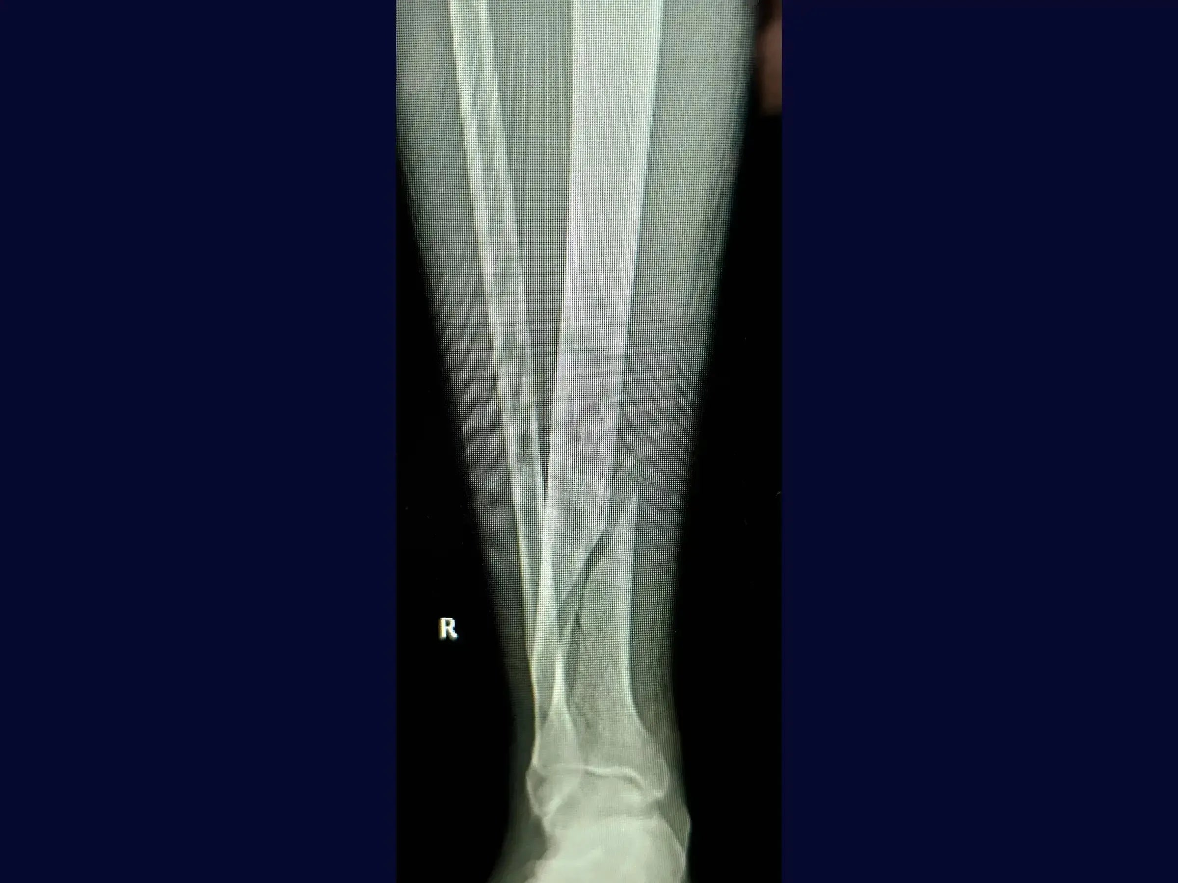 Distal Tibia Fracture - Treatment with Locked Plate