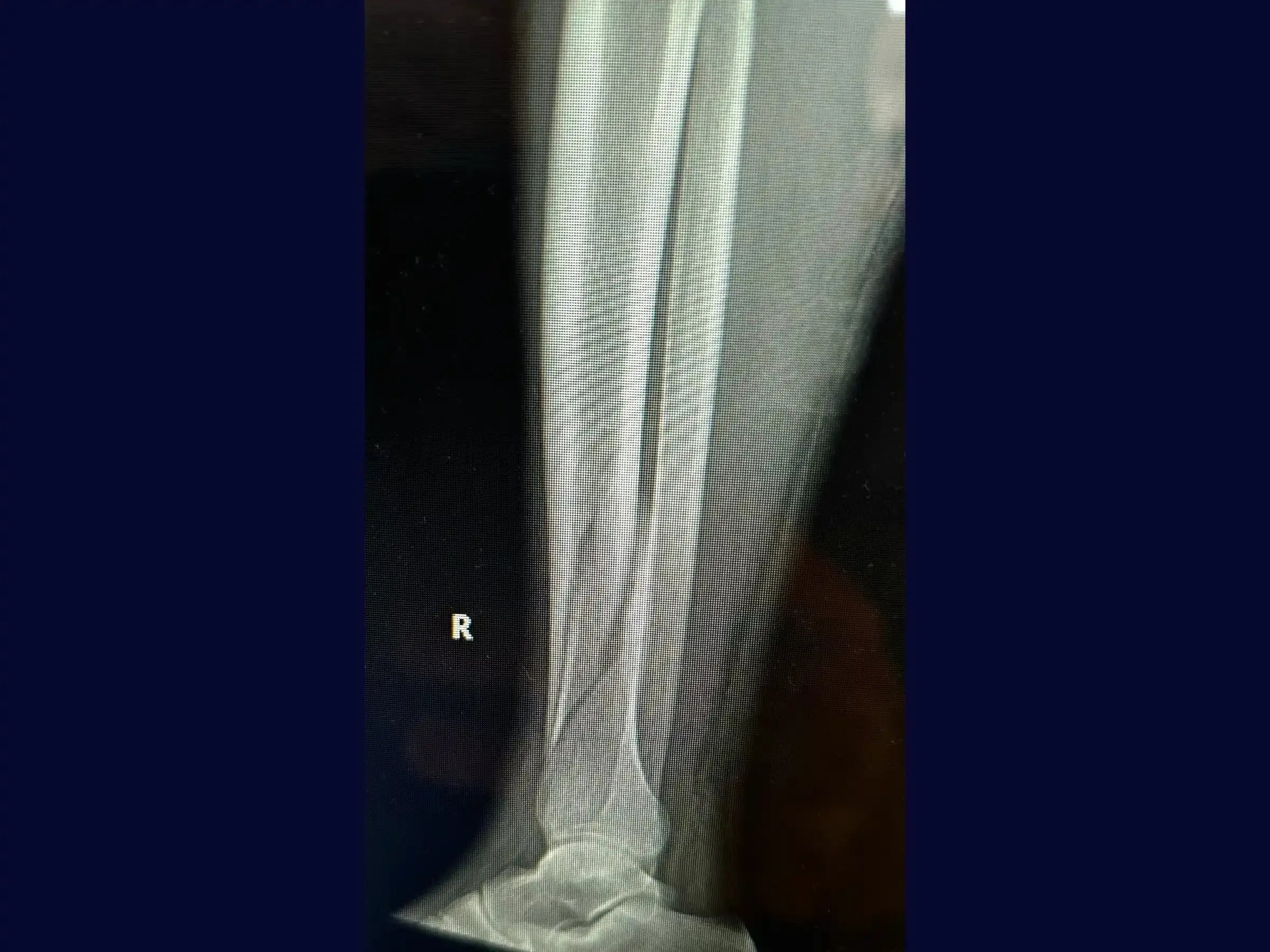 Distal Tibia Fracture - Treatment with Locked Plate