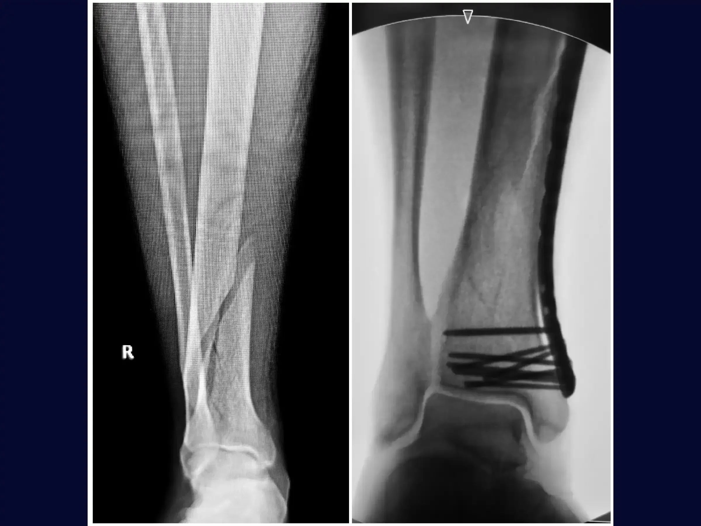 Distal Tibia Fracture - Treatment with Locked Plate