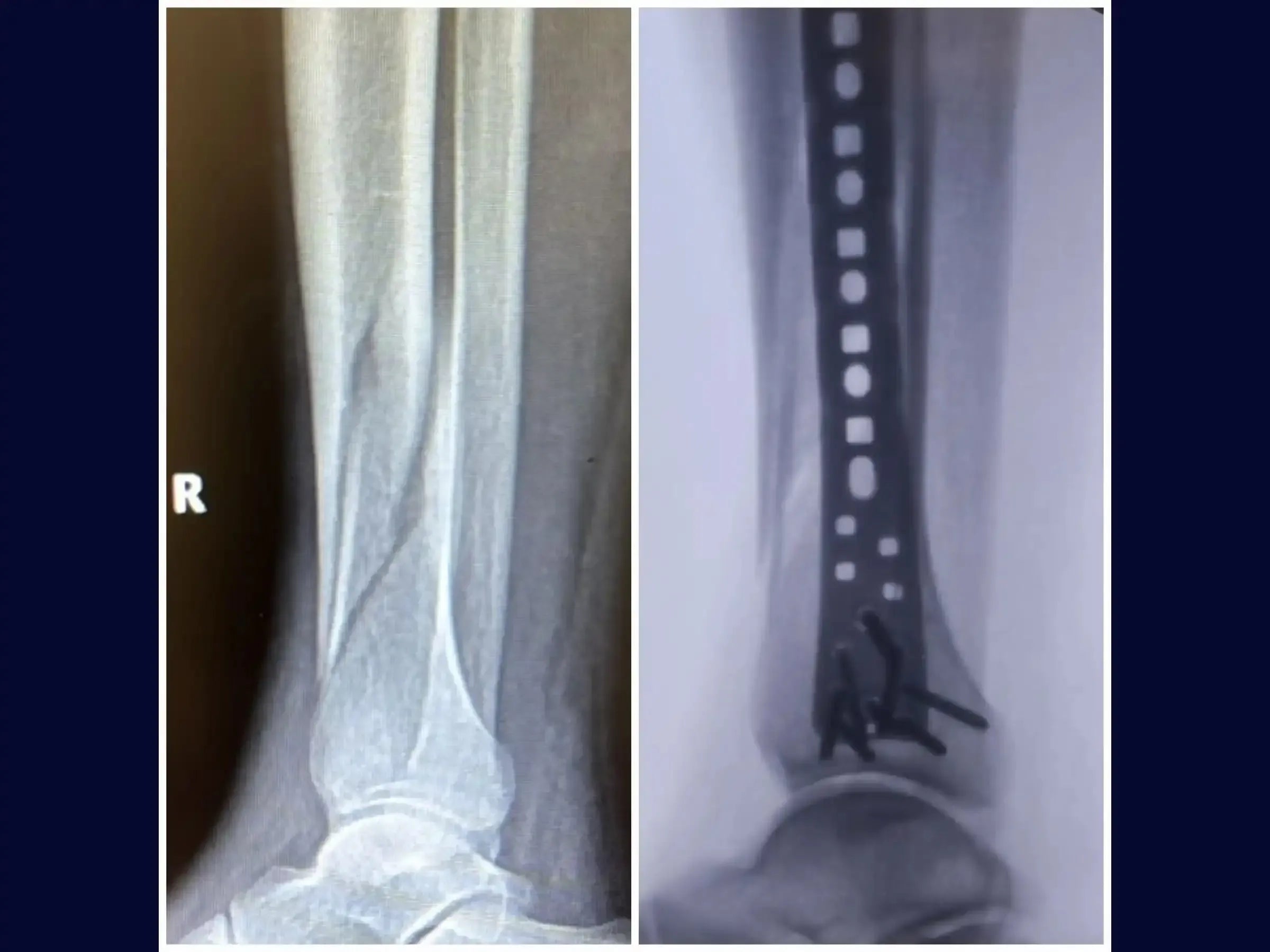 Distal Tibia Fracture - Treatment with Locked Plate