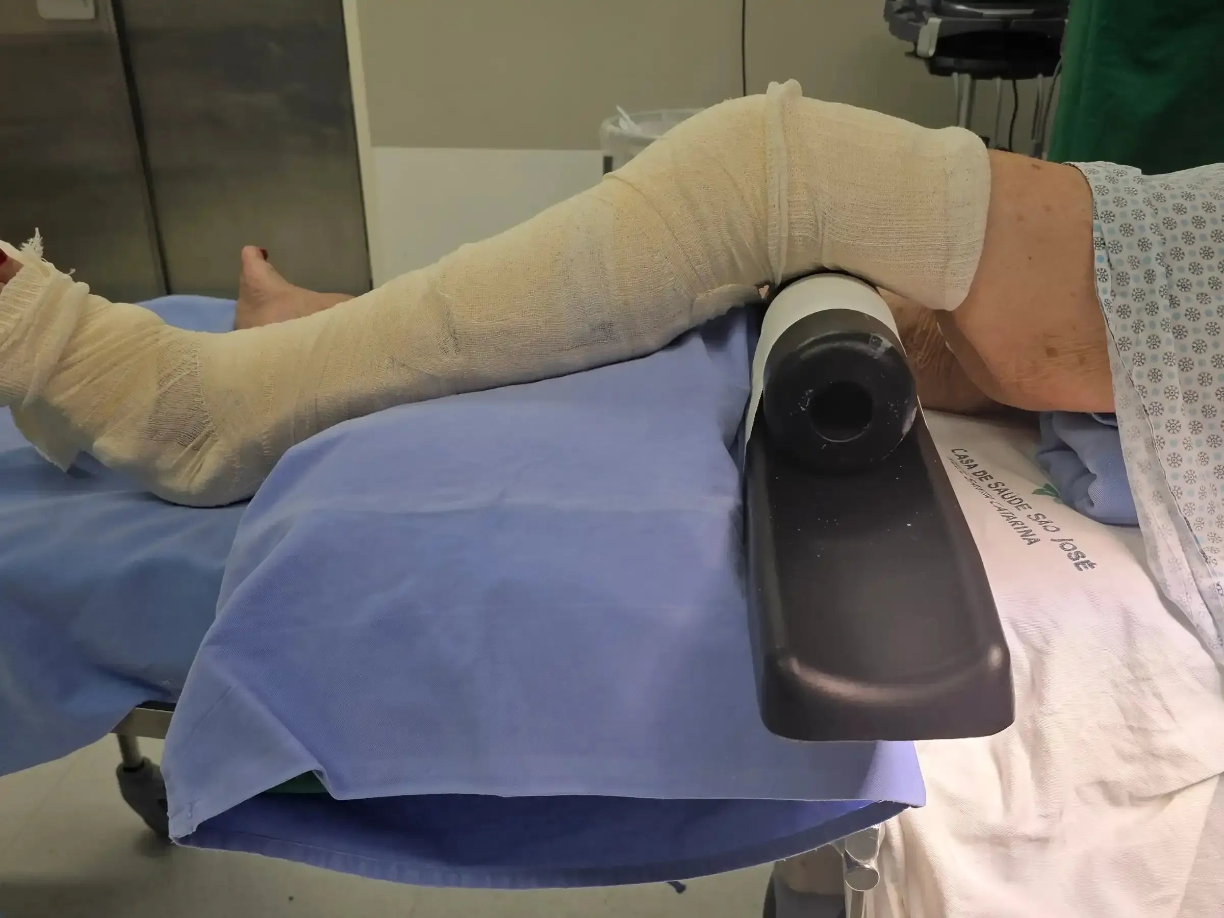 Distal Tibial Diaphyseal Fracture via Intramedullary Nail with Suprapatellar Approach