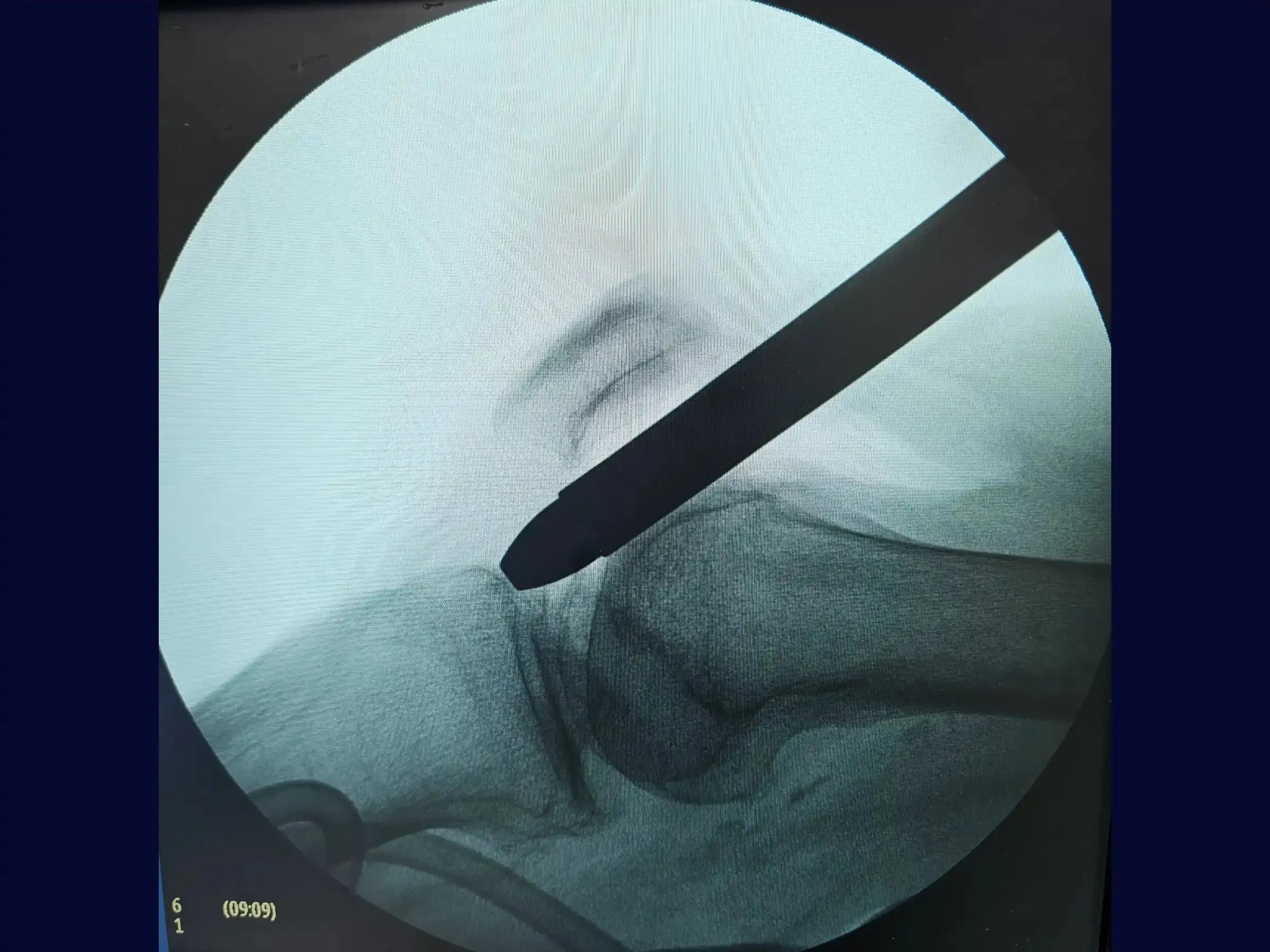 Distal Tibial Diaphyseal Fracture via Intramedullary Nail with Suprapatellar Approach