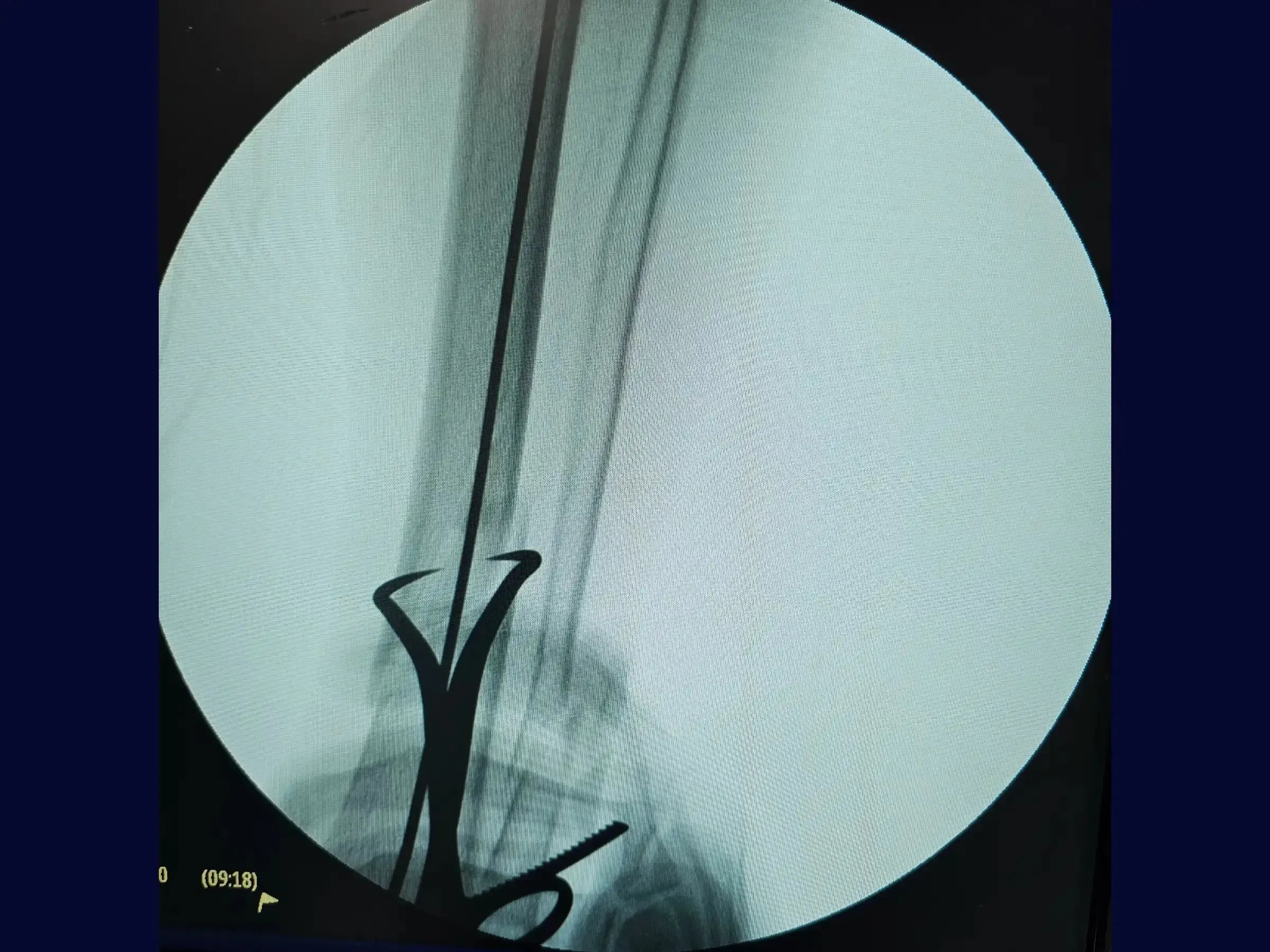 Distal Tibial Diaphyseal Fracture via Intramedullary Nail with Suprapatellar Approach