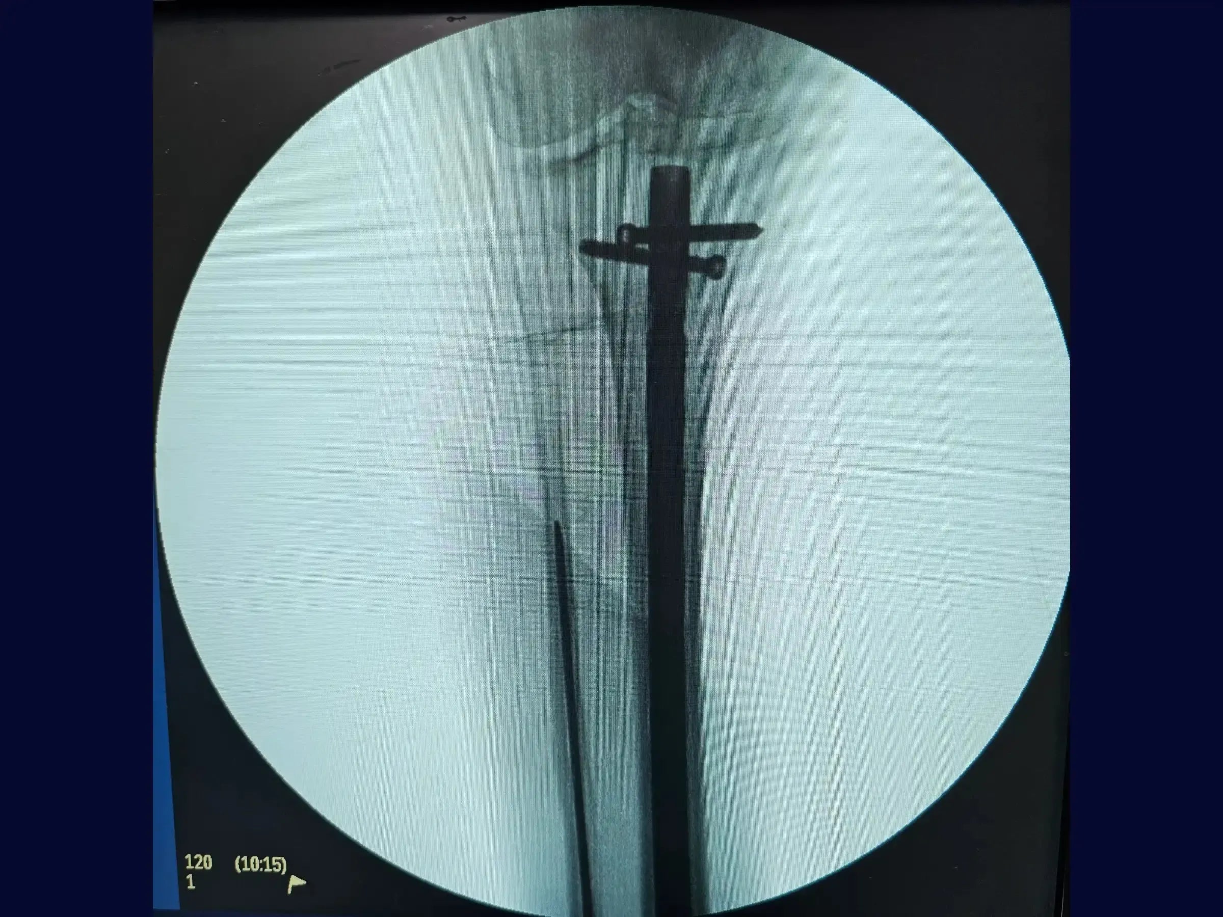 Distal Tibial Diaphyseal Fracture via Intramedullary Nail with Suprapatellar Approach