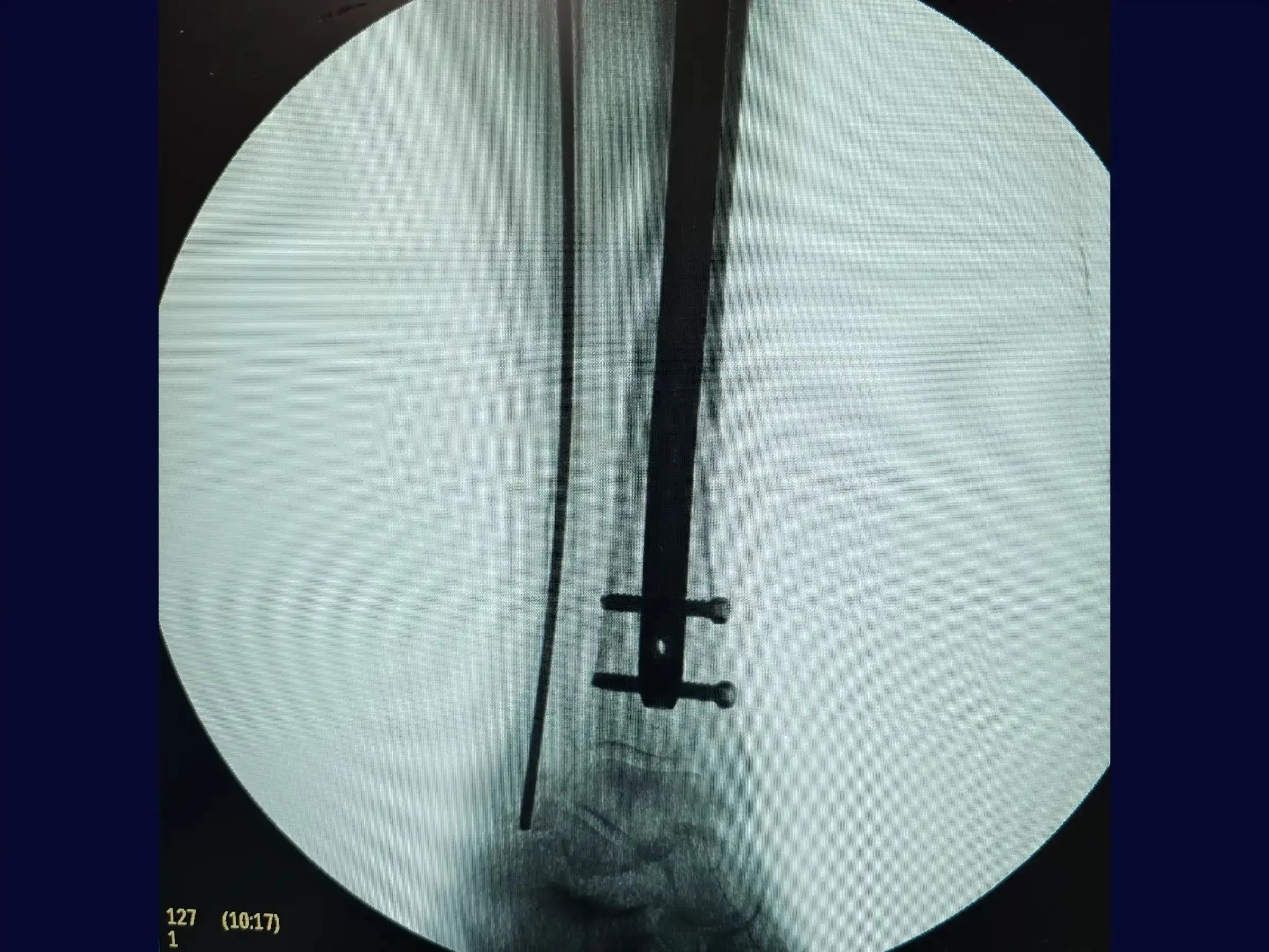 Distal Tibial Diaphyseal Fracture via Intramedullary Nail with Suprapatellar Approach