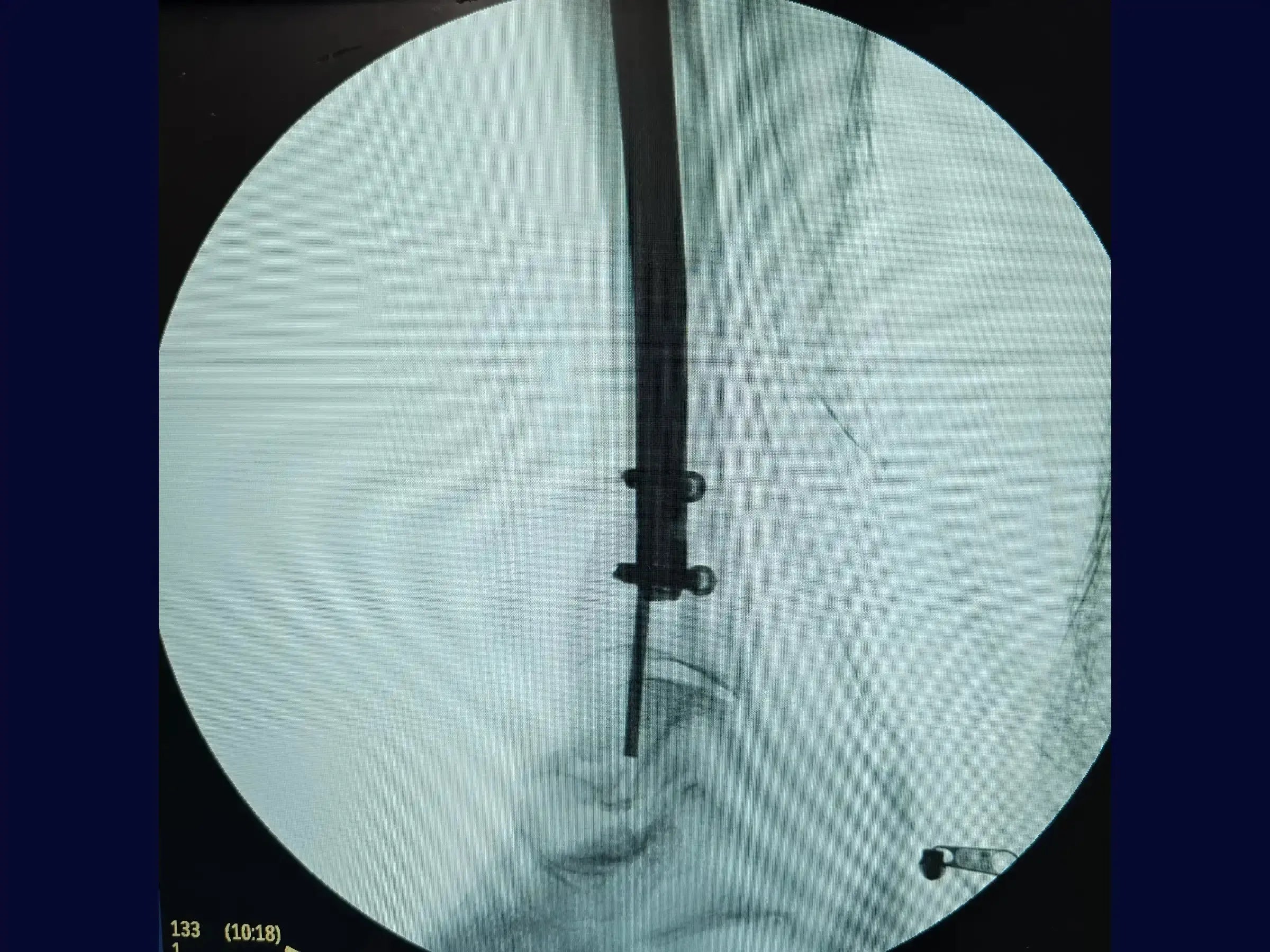 Distal Tibial Diaphyseal Fracture via Intramedullary Nail with Suprapatellar Approach