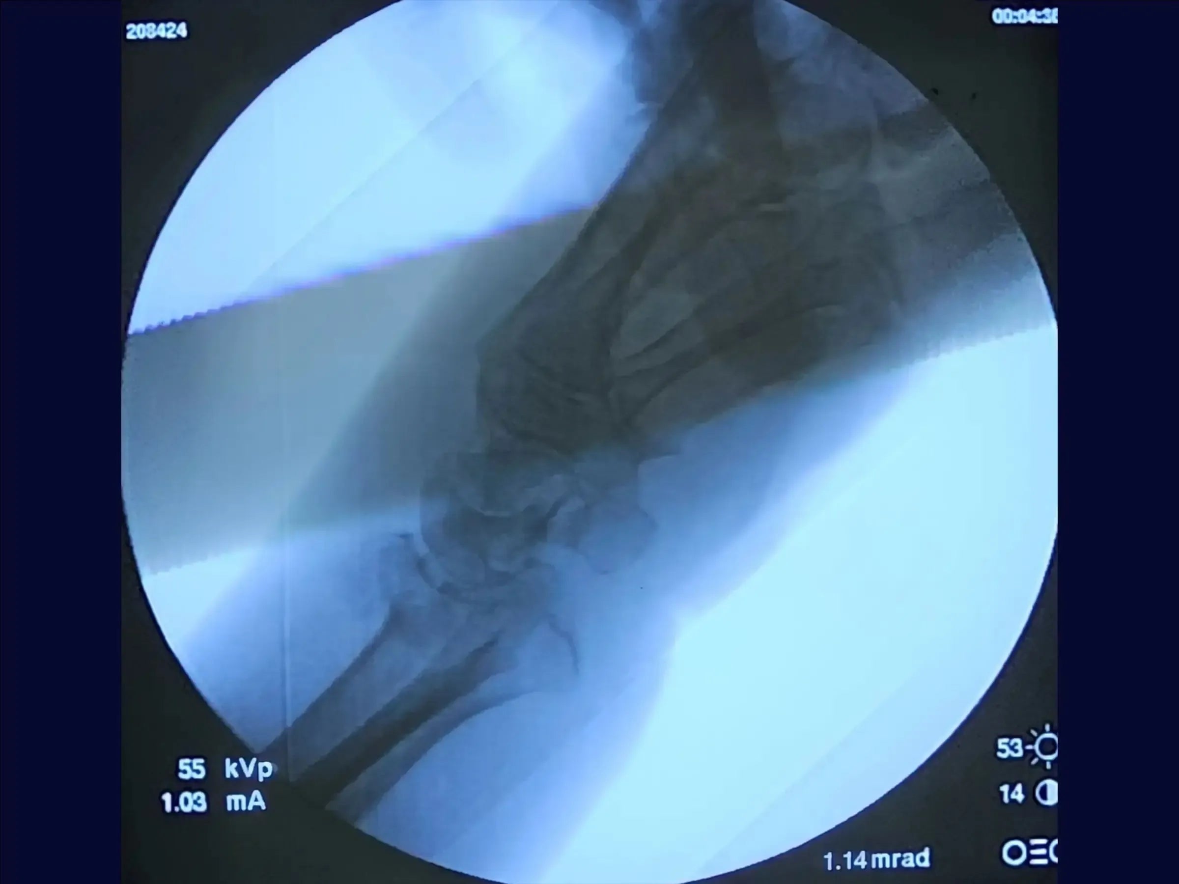 Dorsal Barton's Fracture of the Radius
