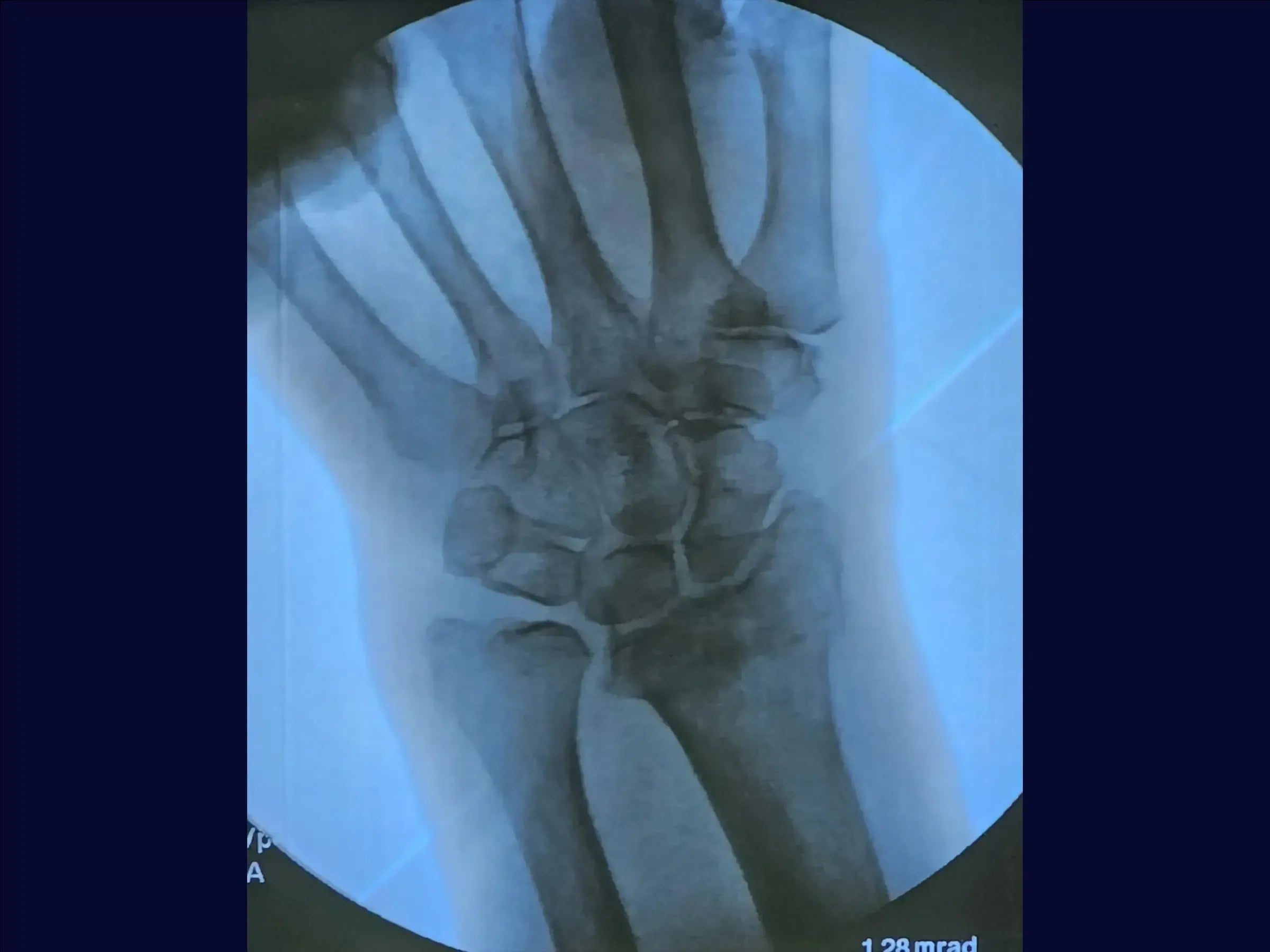 Dorsal Barton's Fracture of the Radius